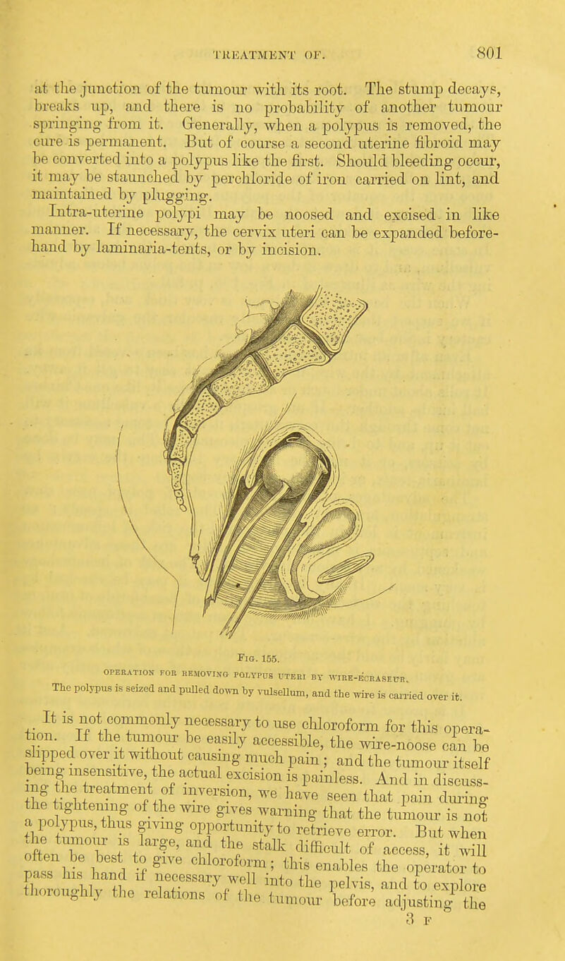 <S01 at the junction of the tumour with its root. The stump decays, breaks up, and there is no probability of another tumour springing from it. Generally, when a polypus is removed, the cure is permanent. But of course a second uterine fibroid may be converted into a polypus like the first. Should bleeding occur, it may be staunched by perchloride of iron carried on lint, and maintained by plugging. Intra-uterine polypi may be noosed and excised in like manner. If necessary, the cervix uteri can be expanded before- hand by laminaria-tents, or by incision. Fig. 155. OPERATION FOR REMOVING POI,YPUg UTERI By WIRE-ECRASEPR The polypus is seized and pulled down by vulsellum, and the wire is carried over it. It is not commonly necessary to use chloroform for this opera- nt™/ the,t™;be ^ily accessible, the wire-noose can be slipped over it without causing much pain ; and the tumour itself being insensitive the actual excision is painless. And in discuss- ing the treatment of inversion, we have seen that pain during he ightening of the wire gives warning that the tumour is not a polypus, thus giving opportunity to retrieve error. But when ot, Tb l\ ?6' T Stalk dif3M °f ^ess, it wi often be best to give chloroform; this enables the operator to 3 F