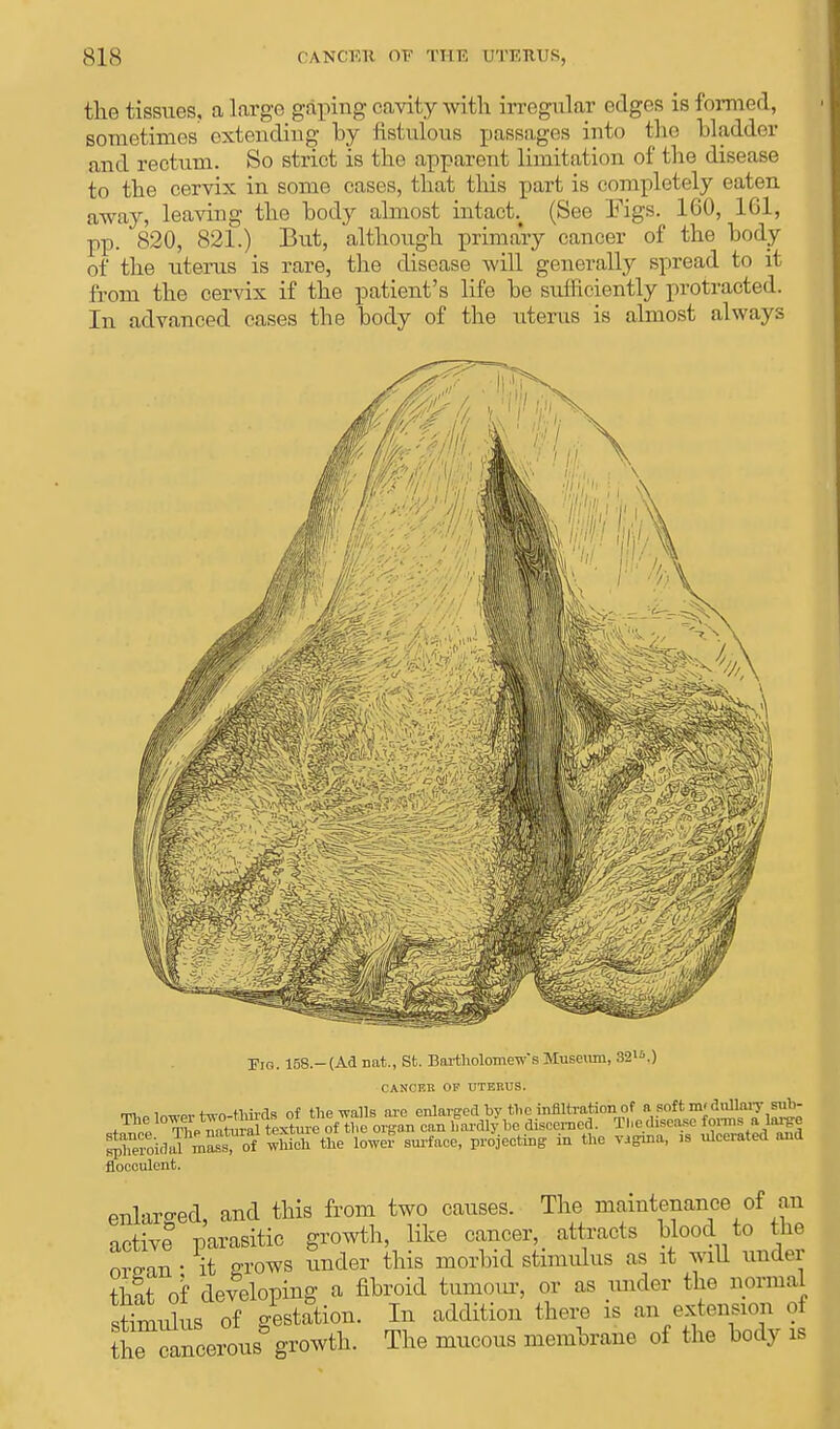 sis C'ANOKK OF THE QTERUS, the tissues, a Large gaping oavity with irregular edges is formed, sometimes extending hy fistulous passages into the bladder and rectum. So strict is the apparent limitation of the disease to the cervix in some cases, that this part is completely eaten away, leaving the body almost intact. (See Figs. 160, 161, pp. '820, 821.) But, although primary cancer of the body of the uterus is rare, the disease will generally spread to it from the cervix if the patient's life be sufficiently protracted. In advanced cases the body of the uterus is almost always Pig. 158.-(Ad nat., St. Bartholomew's Museum, 32l!>.) CANCEB OF UTERUS. S&M ma^of which the low? surface, projecting iu the vigma, .s ulcerated and flocculent. enlarged and this from two causes. The maintenance of an active parasitic growth, like cancer, attracts blood to the orp-an • it grows under this morbid stimulus as it will under that of developing a fibroid tumour, or as under the normal stimulus of gestation. In addition there is an extension of he cScerousg-rowth. The mucous membrane of the body is