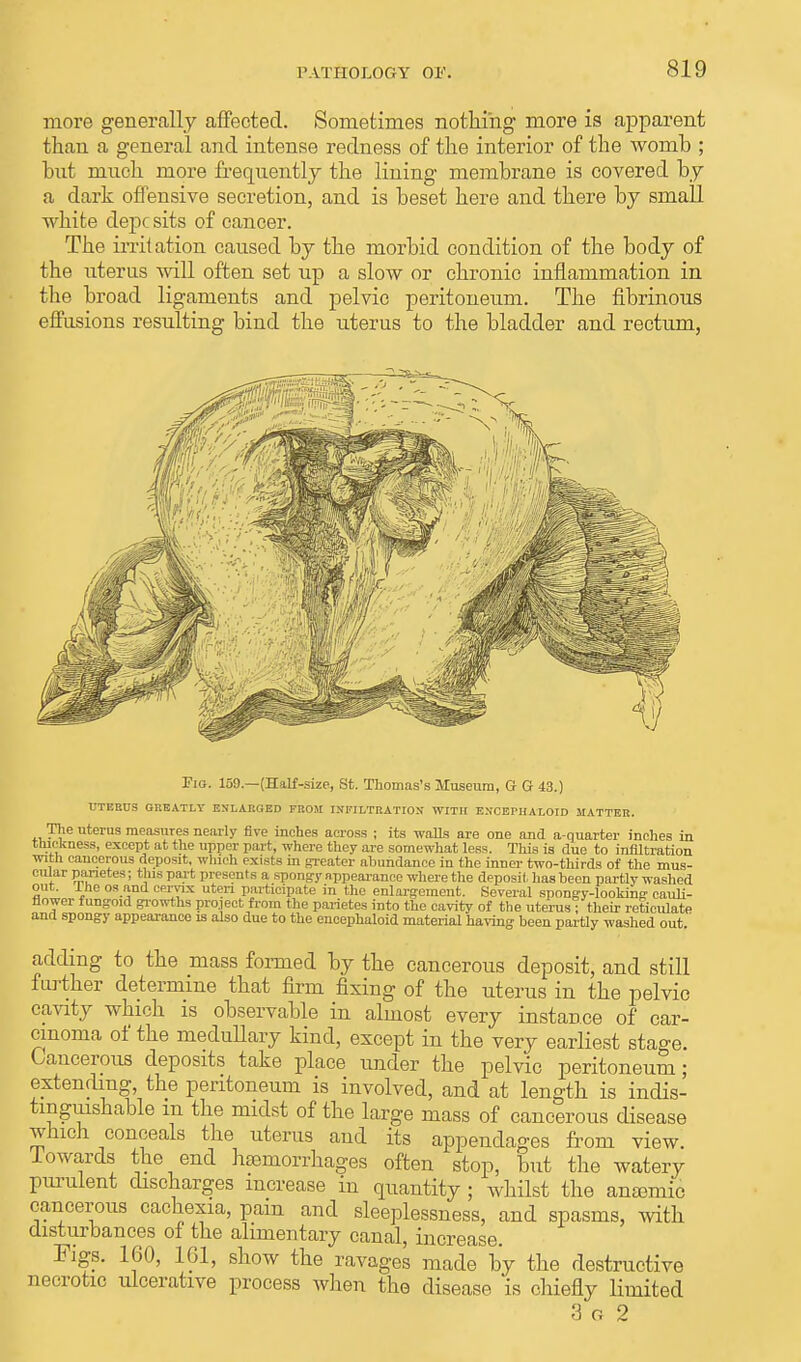 more generally affected. Sometimes nothing more is apparent than a general and intense redness of the interior of the womb ; but much more frequently the lining membrane is covered by a dark offensive secretion, and is beset here and there by small white depc sits of cancer. The irritation caused by the morbid condition of the body of the uterus will often set up a slow or chronic inflammation in the broad ligaments and pelvic peritoneum. The fibrinous effusions resulting bind the uterus to the bladder and rectum, Fig. 159.—(Half-size, St. Thomas's Museum, G G 43.) I-TERUS GREATLY ENLARGED FROM INFILTRATION WITH EJJCEPHALOID MATTER. The uterus measures nearly five inches across ; its walls are one and a-quarter inches in thickness, except at the upper part, where they are somewhat less. This is due to infiltration with cancerous deposit, which exists in greater abundance in the inner two-thirds of the mus- cularpanetes; tins part presents a spongy nppearance where the deposit has been partly washed out. lhe os and cervix uteri participate in the enlargement. Several spongy-looking'cauli- flower fungoid growths project from the parietes into the cavity of the uterus ; their reticulate and spongy appearance is also due to the encephaloid material having been partly washed out.' adding to the mass formed by the cancerous deposit, and still further determine that firm fixing of the uterus in the pelvic cavity which is observable in almost every instance of car- cinoma of the medullary kind, except in the very earliest stage. Cancerous deposits take place under the pelvic peritoneum; extending, the peritoneum is involved, and at length is indis- tinguishable m the midst of the large mass of cancerous disease which conceals the uterus and its appendages from view, lowards the end haemorrhages often stop, but the watery purulent discharges increase in quantity; whilst the anaamic cancerous cachexia, pam and sleeplessness, and spasms, with disturbances of the alimentary canal, increase. Figs. 160, 161, show the ravages made by the destructive necrotic ulcerative process when the disease is chiefly limited 3 o 2