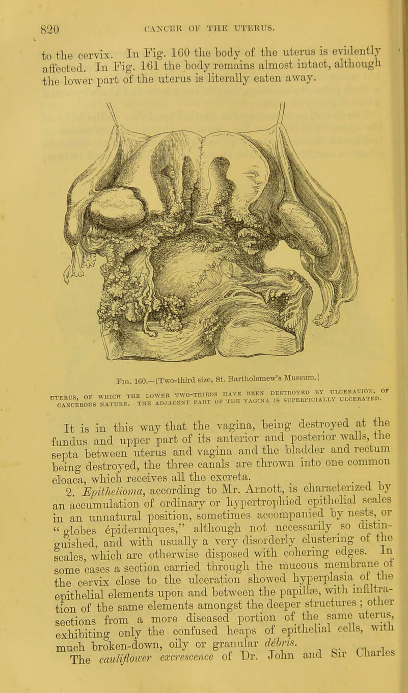 to the cervix. In Fig. 1G0 the hody of the uterus is evidently affected. In Fig. 161 the hody remains almost intact, although the lower part of the uterus is literally eaten away. FlG 160.—[Two-third size, St. Bartholomew's Museum.) It is in this way that the vagina, being destroyed at the fundus and upper part of its anterior and posterior walls, the septa between uterus and vagina and the bladder and rectum being destroyed, the three canals are thrown into one common cloaca, which receives all the excreta. 2 Epithelioma, according to Mr. Aimott, is characterized by an accumulation of ordinary or hypertrophied epithelial scales in an unnatural position, sometimes accompanied by nests, or  globes epidermiques, although not necessarily so distin- guished, and with usually a very disorderly clustering of the scales which are otherwise disposed with cohering edges. In some 'cases a section carried through the mucous membrane ot the cervix close to the ulceration showed hyperplasia ot the epithelial elements upon and between the papillse, with infiltra- tion of the same elements amongst the deeper structures ; other sections from a more diseased portion of the same uterus, exhibiting only the confused heaps of epithelial cells, witli much broken-down, oily or granular dibris. The cauliflower excrescence of Dr. John and hn Uiaxies