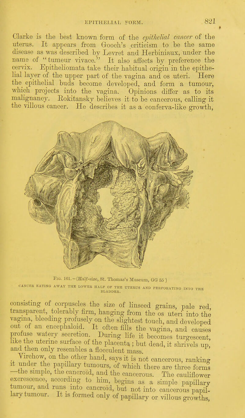 Clarke is the best known form of the epithelial cancer of the uterus. It appears from Grooch's criticism to be the same disease as was described by Levret and Herbiniaux, under the name of  tumeur vivace. It also affects by preference the cervix. Epitheliomata take their habitual origin in the epithe- lial layer of the upper part of the vagina and os uteri. Here the epithelial buds become developed, and form a tumour, which projects into the vagina. Opinions differ as to its malignancy. Eokitansky believes it to be cancerous, calling it the villous cancer. He describes it as a conferva-like growth, Fig. 101.-(Half-size, St. Thomas's Museum, GG 55 ) , ANCHB KAT1KO AWAY THE LOWER HA LP OF THE UTERUS AND PERFORATING INTO THK BLADDER. consisting of corpuscles the size of linseed grains, pale red transparent, tolerably firm, hanging from the os uteri into the vagina, bleeding profusely on the slightest touch, and developed out of an encephaloid. It often fills the vagina, and causes profuse watery secretion During life it becomes turgescent, like the uterine surface of the placenta ; but dead, it shrivels up, and then only resembles a flocculent mass Tii-chow on the other hand, says it is not cancerous, ranking it under the papillary tumours, of which there are three forms —the simple, the cancroid, and the cancerous. The cauliflower excrescence according to him, begins as a simple papillary tumour, and runs mto cancroid, but not into cancerous papil- lary tumour. It is formed only of papillary or villous growths