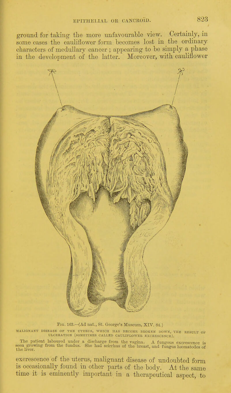 EPITHELIAL OR CANCROID. ground for taking- the more unfavourable view. Certainly, in some cases the cauliflower form becomes lost in the ordinary characters of medullary cancer ; appearing to be simply a phase in the development of the latter. Moreover, with cauliflower Fio. 163.—{Ad nat., St. George's Museum, XXV. 81.) MALIGNANT DISEASE OK THE UTERI S, WHICH HAS BBOOMK IIROKRN DOWN, THE RBStTI/F OK ULCERATION (SOMETIMES CALLED CAULIFLOWER EXCRESCENCE). The patient laboured under a discharge from the vagina. A fungous excrescence is seen growing from the fundus. She had scirrhus of the breast, and fungus hsematodes of the liver. excrescence of the uterus, malignant disease of undoubted form is occasionally found in other parts of the body. At the same time it is eminently important in a therapeutical aspect, to