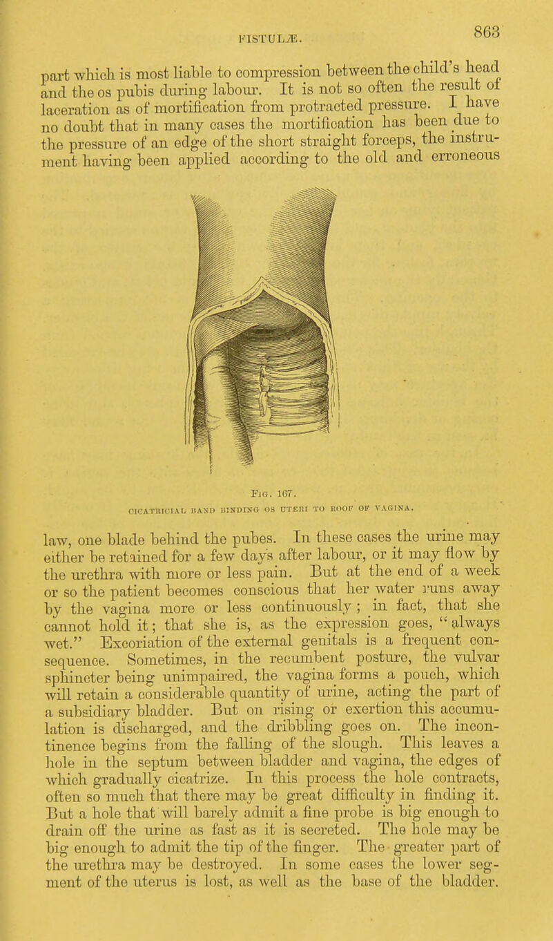 part which is most liable to compression between the child s head and the os pubis during labour. It is not so often the result ot laceration as of mortification from protracted pressure. 1 have no doubt that in many cases the mortification has been due to the pressure of an edge of the short straight forceps, the instru- ment having been applied according to the old and erroneous Pjo. 167. cicatricial, band uisdino os uteitl to roof ok vagina. law, one blade behind the pubes. In these cases the mine may either be retained for a few days after labour, or it may flow by the urethra with more or less pain. But at the end of a week or so the patient becomes conscious that her water runs away by the vagina more or less continuously ; in fact, that she cannot hold it; that she is, as the expression goes,  always wet. Excoriation of the external genitals is a frequent con- sequence. Sometimes, in the recumbent posture, the vulvar sphincter being unimpaired, the vagina forms a pouch, which will retain a considerable quantity of urine, acting the part of a subsidiary bladder. But on rising or exertion this accumu- lation is discharged, and the dribbling goes on. The incon- tinence begins from the falling of the slough. This leaves a hole in the septum between bladder and vagina, the edges of which gradually cicatrize. In this process the hole contracts, often so much that there may be great difficulty in finding it. But a hole that will barely admit a fine probe is big enough to drain off the urine as fast as it is secreted. The bole may be big enough to admit the tip of the finger. The greater part of the urethra may be destroyed. In some cases the lower seg- ment of the uterus is lost, as well as the base of the bladder.
