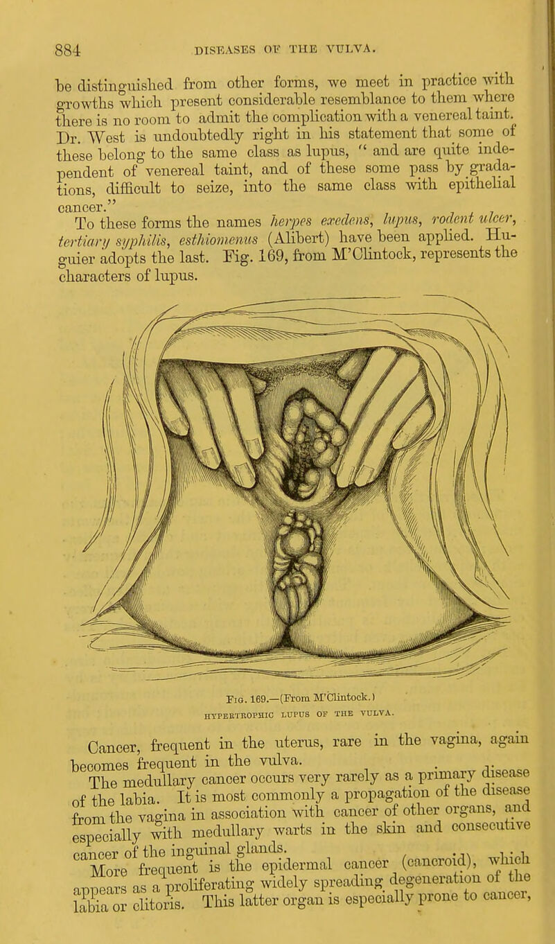 be distinguished from other forms, we meet in practice with growths which present considerable resemblance to them where there is no room to admit the complication with a venereal taint. Dr. West is undoubtedly right in his statement that some of these belong to the same class as lupus,  and are quite inde- pendent of venereal taint, and of these some pass by grada- tions, difficult to seize, into the same class with epithelial cancer. To these forms the names herpes exedens, lupus, rodent ulcer, tertian/ syphilis, esthiomenus (Alibert) have been applied. Hu- guier adopts the last. Fig. 169, from M'Clintock, represents the characters of lupus. Eio. 169.—(From M'Clintock.) HYPERTROPHIC LUPUS OF THE VULVA. Cancer, frequent in the uterus, rare in the vagina, again becomes frequent in the vulva. . The medullary cancer occurs very rarely as a primary disease of the labia. It is most commonly a propagation oi the disease from the vagina in association with cancer of other organs, and especially with medullary warts in the skin and consecutive ^t^t^^ cancer (cancroid), which vroeara as a proliferating widely spreading degeneration of the labia or clitoris. This latter organ is especially prone to cancer,