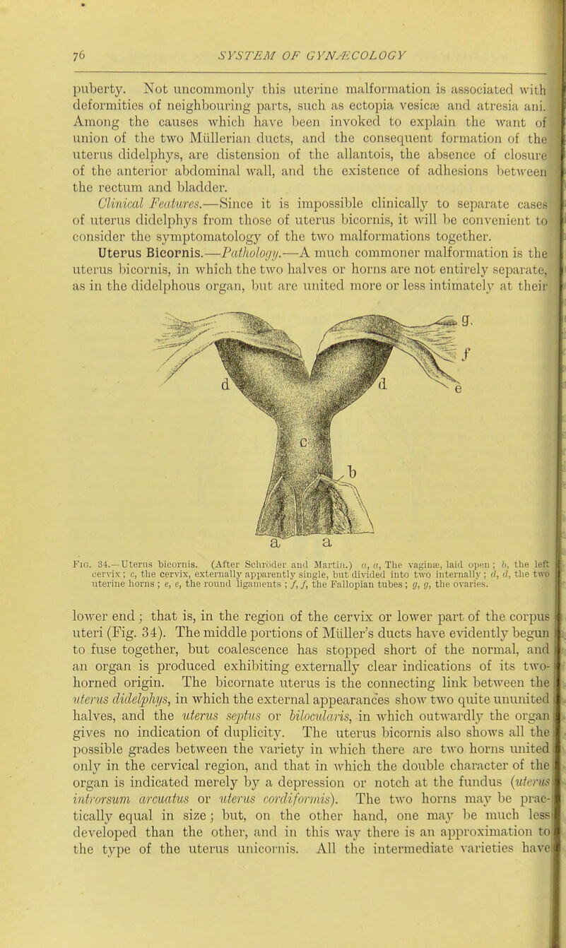 puberty. Not uncommonl}^ this uterine malformation is associated with deformities of neighbouring parts, such as ectopia vesica; and atresia ani. Among the causes which have been invoked to explain the want oi union of the two Miillerian ducts, and the consequent formation of the uterus didelphys, are distension of the allantois, the absence of closure of the anterior abdominal wall, and the existence of adhesions between the rectum and bladder. Clinical Features.—Since it is impossible clinically to seiDarate cases of utertis didelphys from those of uterus bicornis, it will be convenient to consider the symptomatology of the two malformations together. Uterus Bicornis.—Pathology.—A much commoner malformation is the txtertis l)icornis, in which the two halves or horns are not entirely separate, as in the didelphous organ, but arc united more or less intimatel}' at their Fio. 34.—Uterus bicornis. (After Schroder and Martin.) (t, a, The vaginic, laid open ; b, the left cervix ; c, the cervix, exteniallj' apparently single, but divided into two internally ; </, d, the two uterine horns ; c, c, the round ligaments ; /, /, the Fallopian tubes; g, g, the ovaries. lower end; that is, in the region of the cervix or lower part of the corpus ttteri (Fig. 34). The middle portions of Miiller's ducts have evidentl}'' begun to fuse together, but coalescence has stopped short of the normal, and an organ is produced exhibiting externally clear indications of its two- horned origin. The bicornate uterus is the connecting link between the uterus didelphys, in which the external appearances show two quite untxnited halves, and the uterus senilis or hilocularis, in which outwardly the organ gives no indication of duplicity. The uterus bicornis also shows all the possible grades between the variety in w^hich there are two horns united only in the cervical region, and that in which the double character of the organ is indicated merely by a depression or notch at the fundus {uterus introrsuni arcuatus or iiterus cordiformis). The two horns may be prac- tically equal in size; but, on the other hand, one may be much lessi developed than the other, and in this Avay there is an approximation to the type of the uterus unicornis. All the intermediate varieties havei