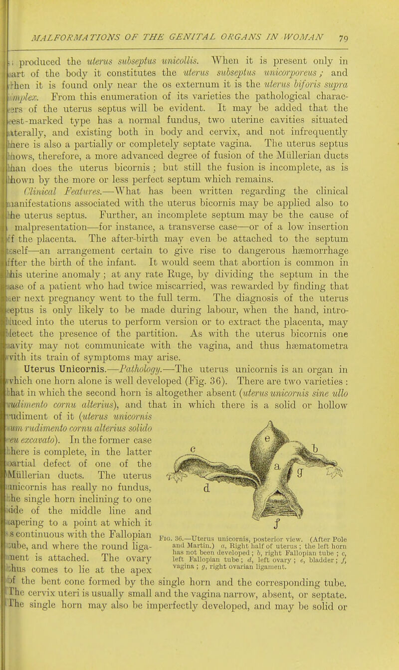 . produced the ut&rus subseptus unicollis. When it is present only in art of the body it constitutes the uterus suhseptws imicorporeus; and hen it is found only near the os externum it is the uterus biforis supra ii/)lex. From this enumeration of its varieties the pathological charac- ■is of the uterus septus will be evident. It may be added that the fst-marked type has a normal fundus, two uterine cavities situated iterally, and existing both in body and cervix, and not infrequently lere is also a partially or completely septate vagina. The uterus septus lows, therefore, a more advanced degree of fusion of the Miillerian ducts in does the uterus bicornis ; but still the fusion is incomplete, as is iiown by the more or less perfect septum which remains. CHniml Features.—What has been written regarding the clinical lanifestations associated with the uterus bicornis may be applied also to lie uterus septus. Further, an incomplete septrun may be the cause of malpresentation—for instance, a transverse case—or of a low insertion t the placenta. The after-birth may even be attached to the septum M>lf—an arrangement certain to give rise to dangerous hsemoii'hage iter the birth of the infant. It would seem that abortion is common in his uterine anomaly; at any rate Ruge, by dividing the septum in the ase of a patient who had twice miscarried, was rewarded by finding that ill- next pregnancy went to the full term. The diagnosis of the uterus eptus is only likely to be made during labour, when the hand, intro- uced into the uterus to perform version or to extract the placenta, may li'tect the presence of the partition. As with the uterus bicornis one i\ ity may not communicate with the vagina, and thus ha^matometra ith its train of symptoms may arise. Uterus Unieopnis.—Fathology.-—-The utei'us unicornis is an organ in vhich one horn alone is well developed (Fig. 36). There are two varieties : bhat in which the second horn is altogether absent (iderus unicornis sine ullo iudimento cornu alterms), and that in which there is a solid or hollow •''udiment of it (uterus unicornis '^urn ruclimento cormi alterius solido ■ eu excavato). In the former case !:here is complete, in the latter oartial defect of one of the ^Miillerian ducts. The uterus ;:inicornis has really no fundus, ohe single horn inclining to one irtde of the middle line and •sapering to a point at which it ^ s continuous with the Fallopian oube, and where the round liga- iment is attached. The ovary 1:hus comes to lie at the apex □f the bent cone formed by the single horn and the corresponding tube. The cervix uteri is usually small and the vagina narrow, absent, or septate. The single horn may also be imperfectly developed, and may be solid or l''io. 3(i.—Uterus unicornis, posterior view. (After Pole and Martin.) a, Riglit half of uterus ; the left horn has not been developed; b, right Fallopian tube ; c, left Fallopian tube; d, left ovary ; t, bladder; /, vagina ; g, right ovarian ligament.