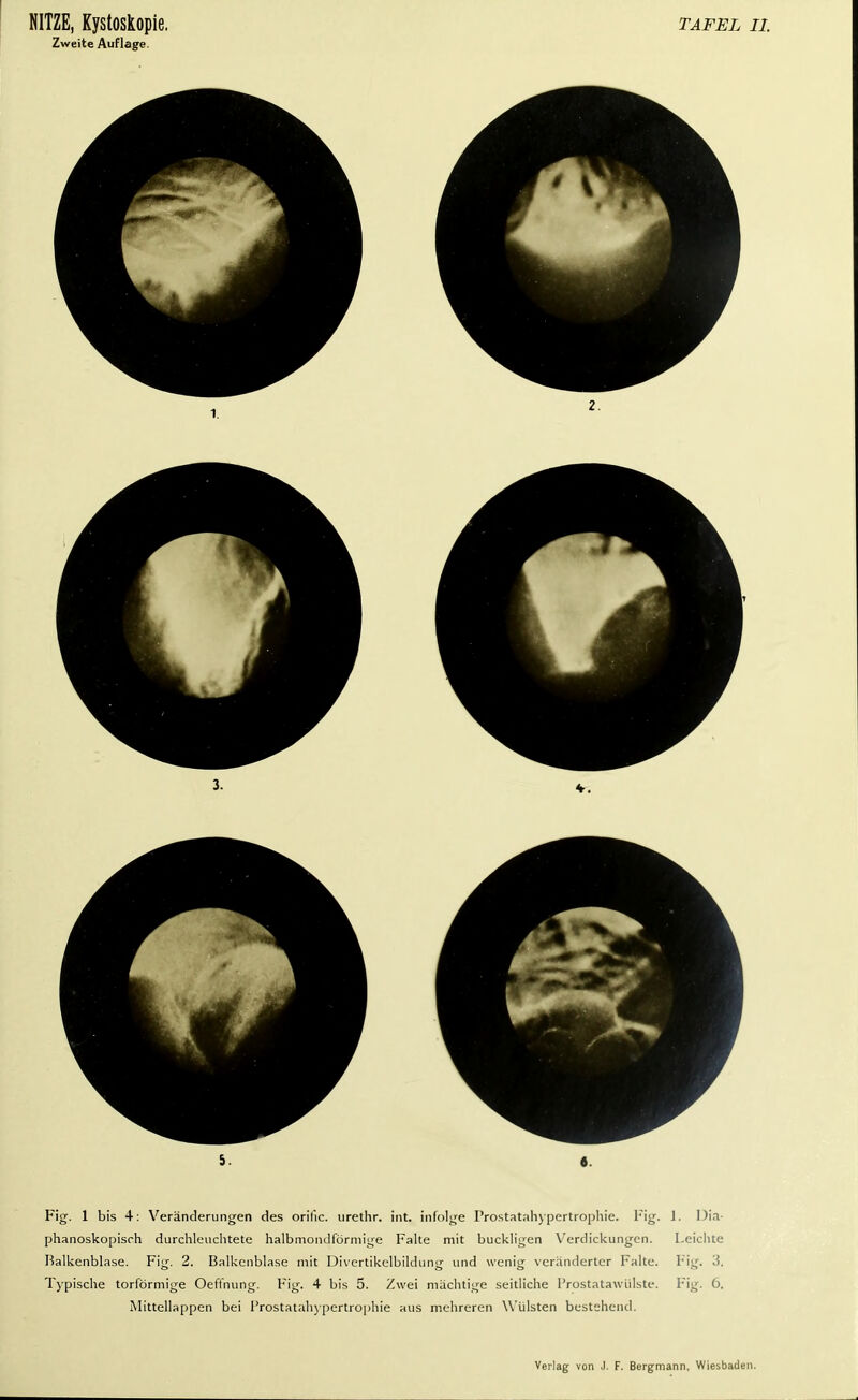 Zweite Auflage. 2. Fig. 1 bis 4: Veränderungen des orific. urethr. int. infolge Prostatahypertrophie. Fig. 1. Dia- phanoskopisch durchleuchtete halbmondförmige Falte mit buckligen Verdickungen. Leichte Balkenblase. Fig. 2. Balkenblase mit Divertikelbiklung und wenig veränderter Falte. Fig. 3. Typische torförmige Oeffnung. Fig. 4 bis 5. Zwei mächtige seitliche Prostatawülste. Fig. 6. Mittellappen bei Prostatahypertrophie aus mehreren Wülsten bestehend.