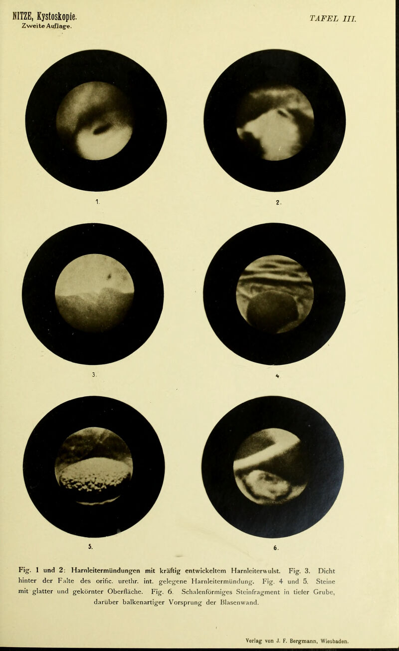 Zweite Auflag-e. Fig. 1 und 2: Harnleitermündungen mit kräftig entwickeltem Harnleiterwulst. Fig. 3. Dicht hinter der Falte des orific. urethr. int. gelegene Harnleitermündung. Fig. 4 und 5. Steine mit glatter und gekörnter Oberfläche. Fig. 6. Schalenförmiges Steinfragment in tiefer Grube, darüber balkenartiger Vorsprung der Blasenwand.