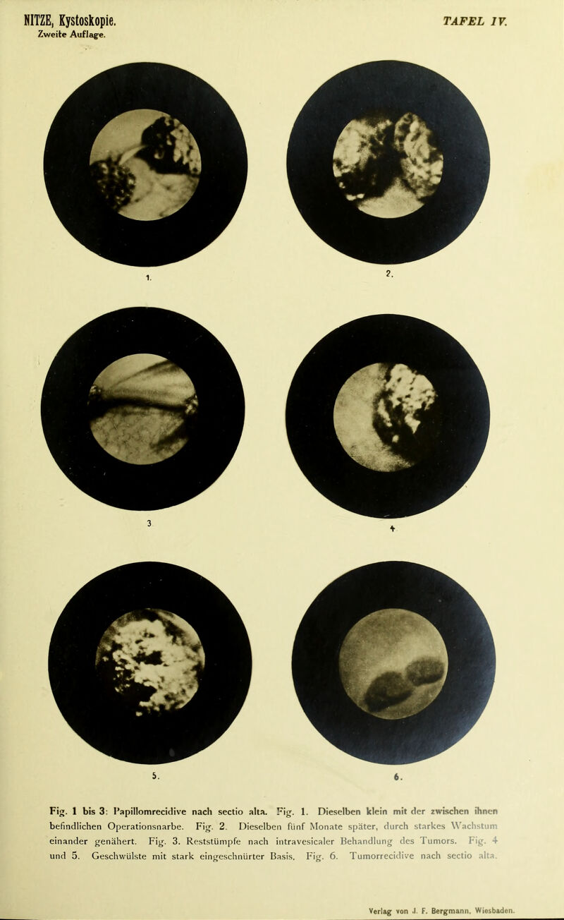 Zweite Auflage. Fig. 1 bis 3: I'apillomrecidive nach Sectio alta. Fig. 1. Dieselben klein mit der zwischen ihnen befindlichen Operationsnarbe. Fig. 2. Dieselben fünf Monate später, durch starkes Wachstum einander genähert. Fig. 3. Reststümpfe nach intravesicaler Behandlung des Tumors. Fig. 4 und 5. Geschwülste mit stark eingeschnürter Basis. Fig. 6. Tumorreciilive nach Sectio alta.