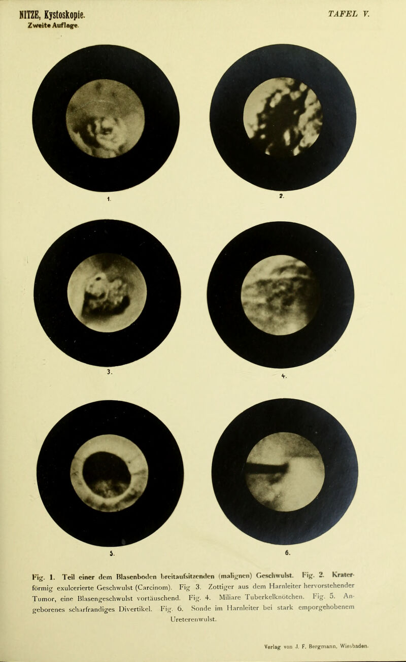 Zweite Auflag« 5. 6. Fig. 1. Teil einer dem Blasenboden breitaufsitzenden (malignen) Geschwulst. Fig. 2. Krater- förmig exuleerierte Geschwulst (Carcinom). Fig 3. Zottiger aus dem Harnleiter hervorstehender Tumor, eine Blasengeschwulst vortäuschend. Fig. 4. Miliare Tuberkelknötchen. Fig. 5. An- geborenes scharfrandiges Divertikel. Fig. 6. Sonde im Harnleiter bei stark emporgehobenem Ureterenwulst.