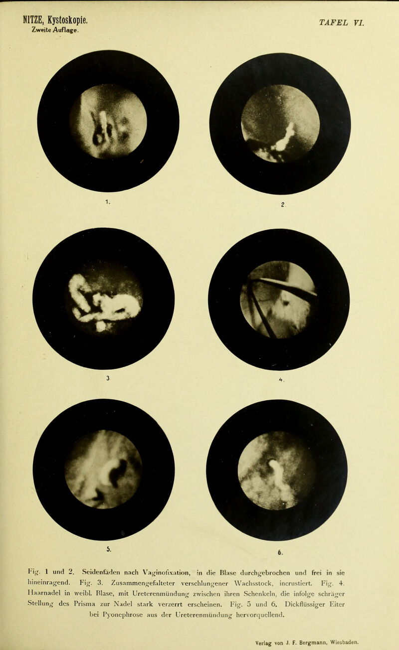 Zweite Auflage rig. 1 und 2. Seidenfaden nach Vaginofixation, in die Blase durchgebrochen und frei in sie hineinragend. Fi«;. 3. Zusammengefalteter verschlungener Wachsstock, incrustiert. Fig. 4 Haarnadel in weibl. Blase, mit Ureterenmündung zwischen ihren Schenkeln, die infolge schräger Stellung des Prisma zur Nadel stark verzerrt erscheinen. Fig. 5 und 6. Dickflüssiger Eiter bei Pyonephrose aus der Ureterenmündung hervorquellend.