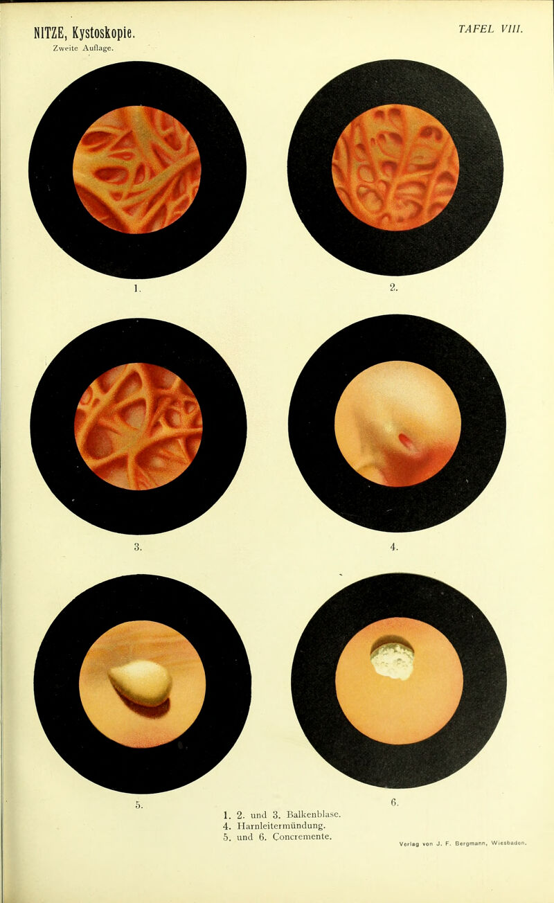 Zweite Auflage. TAFEL VIII. 1. 2. und 3. Balkenblasc. 4. Harnleitermündung. 5. und 6. Concremente.
