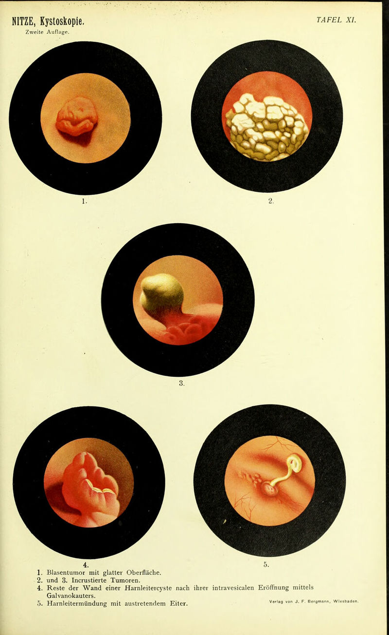 Zweite Auflage. 4. 5. 1. Blasentumor mit glatter Oberfläche. 2. und 3. Incrustierte Tumoren. 4. Reste der Wand einer Harnleitercyste nach ihrer intravesicalen Eröffnung mittel Galvanokauters. 5. Harnleitermündung mit austretendem Eiter. v<'9 von J' F B