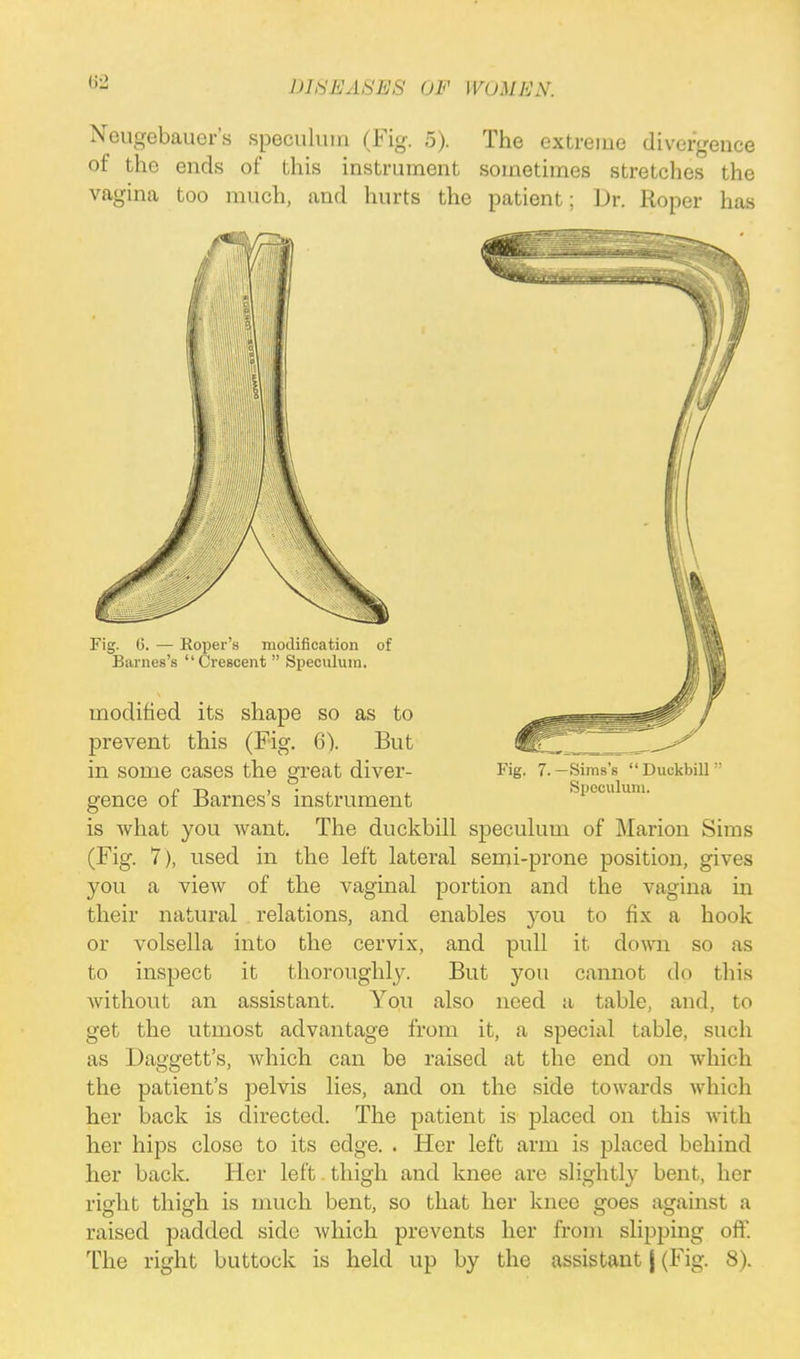 Neugebauer's speculum (Fig. 5). The extreme divergence of the ends of this instrument sometimes stretches the vagina too much, and hurts the patient; Dr. Roper has gence of Barnes's instrument is what you Avant. The duckbill speculum of Marion Sims (Fig. 7), used in the left lateral semi-prone position, gives you a view of the vaginal portion and the vagina in their natural relations, and enables you to fix a hook or volsella into the cervix, and pull it down so as to inspect it thoroughly. But you cannot do this without an assistant. You also need a table, and, to get the utmost advantage from it, a special table, such as Daggett's, which can be raised at the end on which the patient's pelvis lies, and on the side towards which her back is directed. The patient is j)laced on this with her hips close to its edge. . Her left arm is placed behind her back. Her left. thigh and knee are slightly bent, her right thigh is much bent, so that her knee goes against a raised padded side which prevents her from slipping off. The right buttock is held up by the assistant j (Fig. 8).