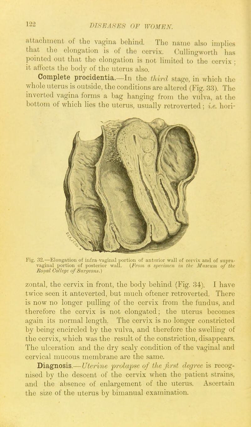 attachment of the vagina behind. The name also implies that the elongation is of the cervix. CulHngwortb has pointed out that the elongation is not limited to the cervix . it affects the body of the uterus also. Complete procidentia.—In the third stage, in which the whole uterus is outside, the conditions are altered (Fig. 38). The inverted vagina forms a bag hanging from the vulva, at the bottom of which lies the uterus, usually retroverted; i.e. hori- Fig. 32.—Elongation of infra-vaginal portion of anterior wall of cervix and of supra- vaginal portion of posterior wall. {From a specimen in the Museum of the Royal College of Surgeons.) zontal, the cervix in front, the body behind (Fig. 34). I have twice seen it anteverted, but much oftener retroverted. There is now no longer pulling of the cervix from the fundus, and therefore the cervix is not elongated; the uterus becomes again its normal length. The cervix is no longer constricted by being encircled by the vulva, and therefore the swelling of the cervix, which was the result of the constriction, disappears. The ulceration and the dry scaly condition of the vaginal and cervical mucous membrane are the same. Diagnosis.—Uterine prolapse of the first degree is recog- nised by the descent of the cervix when the patient strains, and the absence of enlargement of the uterus. Ascertain the size of the uterus by bimanual examination.