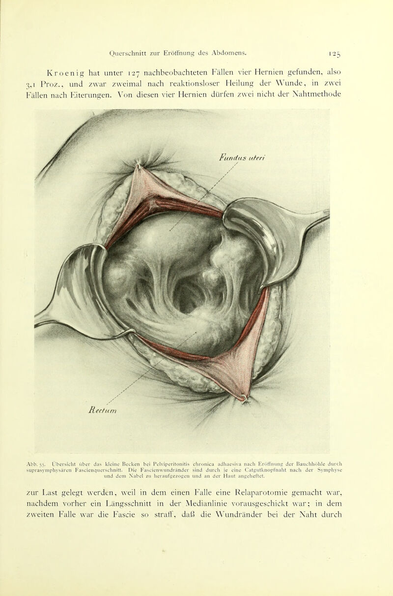 Kroenig hat unter 127 nachbeobachteten Fällen vier Hernien gefunden, also 3,1 Proz., und zwar zweimal nach reaktionsloser Heilung der Wunde, in zwei Fällen nach Fiterungen. \'on diesen vier Hernien dürfen zwei nicht der Xahtmethode Abb. 55. LJbersiclit über das kleine Becken bei Pelviperitonitis clironica adhaesiva nach Eröffnung der Bauchhöhle durch suprasymphysären Fascieiiquersclinitt. Die Fascienwundränder sind durch je eine Catgiitknopfnaht nach der Symphyse und dem Nabel zu heraufgezosen und an der Haut angeheftet. zur Last gelegt werden, weil in dem einen Falle eine Relaparotomie gemacht war, nachdem vorher ein Längsschnitt in der Medianlinie vorausgeschickt war; in dem zweiten Falle war die Fascie so straff, daß die Wundränder bei der Naht durch