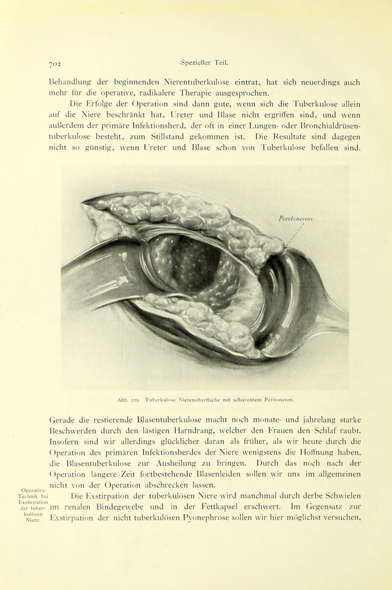 Behandlung der beginnenden Nierentuberkulose eintrat, hat sich neuerdings auch mehr für die operative, radikalere Therapie ausgesprochen. Die Erfolge der Operation sind dann gute, wenn sich die Tuberkulose allein auf die Niere beschränkt hat, Ureter und Blase nicht ergritten sind, und wenn außerdem der primäre Infektionsherd, der oft in einer Lungen- oder Bronchialdrüsen- tuberkulose besteht, 2um Stillstand gekommen ist. Die Resultate sind dagegen nicht so günstig, wenn Ureter und Blase schon von Tuberkulose befallen sind. Abb. 220. Tuberkulöse XiereuoberlUiclie mit adliärentem Peritoneuiii. Gerade die restierende Blasentuberkuluse macht noch monate- und jahrelang starke Beschwerden durch den lästigen Harndrang, welcher den Frauen den Schlaf raubt. Insofern sind wir allerdings glücklicher daran als früher, als wir heute durch die Operation des primären Infektionsherdes der Niere wenigstens die Hottnung haben, die Blasentuberkulose zur Ausheilung zu bringen. Durch das noch nach der Operation längere Zeit fortbestehende Blasenleiden sollen wir uns im allgemeinen nicht von der ()perati()n abschrecken lassen. Operative Technik bei Die Elxstirpation der tuberkulösen Niere wird manchmal durch derbe Schwielen der tubei- im renalen Bindegewebe und in der Fettkapsel erschwert. Im Gegensatz zur 'Niere. Exstirpation der nicht tuberkulösen Pyonephrose sollen wir hier möglichst versuchen.