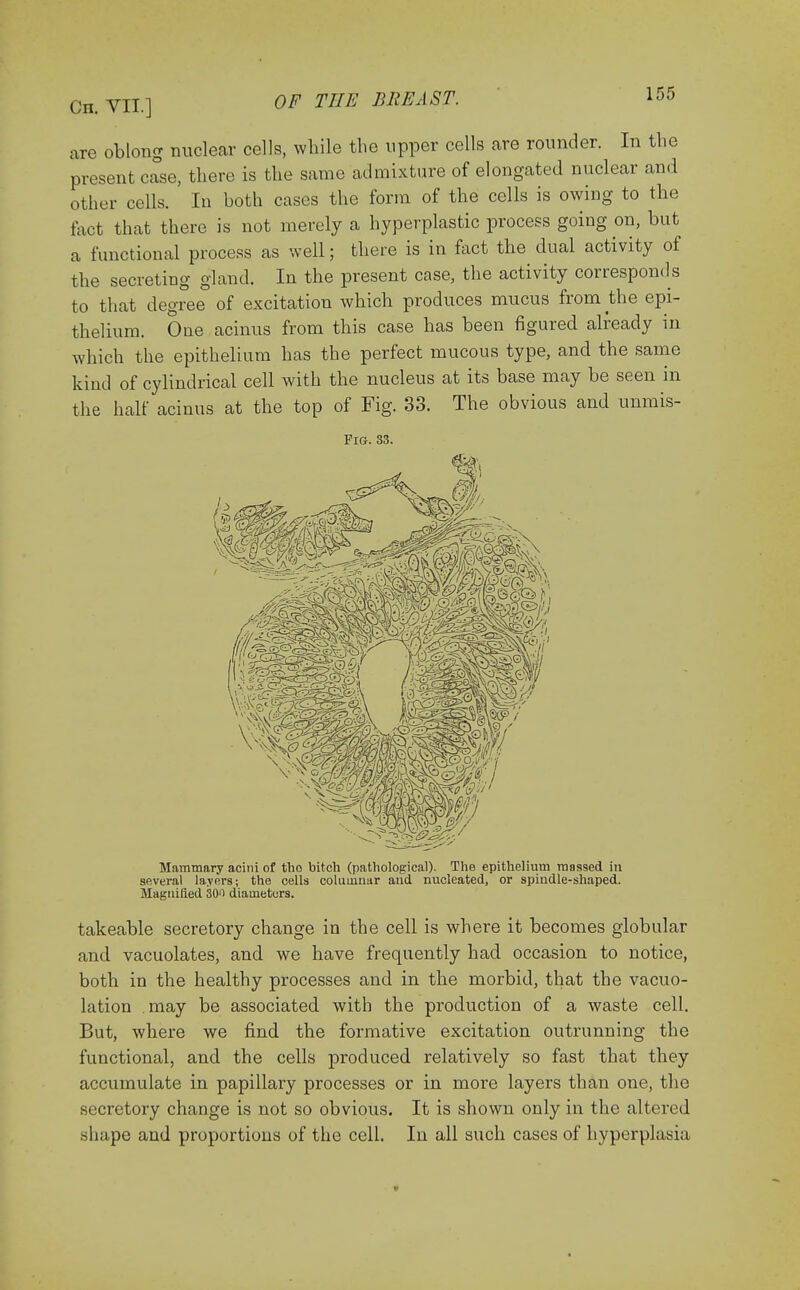 arc oblong nuclear cells, while the upper cells are rounder. In the present case, there is the same admixture of elongated nuclear and other cells. In both cases the form of the cells is owing to the fact that there is not merely a hyperplastic process going on, but a functional process as well; there is in fact the dual activity of the secreting gland. In the present case, the activity corresponds to that degree of excitation which produces mucus from the epi- thelium. Oue acinus from this case has been figured already in which the epithelium has the perfect mucous type, and the same kind of cylindrical cell with the nucleus at its base may be seen in the half acinus at the top of Fig. 33. The obvious and unmis- FlG. 33. Mammary acini of tho bitch (pathological). The epithelium mossed in several layers; the cells columnar and nucleated, or spindle-shaped. Magnified 300 diameters. takeable secretory change in the cell is where it becomes globular and vacuolates, and we have frequently had occasion to notice, both in the healthy processes and in the morbid, that the vacuo- lation may be associated with the production of a waste cell. But, where we find the formative excitation outrunning the functional, and the cells produced relatively so fast that they accumulate in papillary processes or in more layers than one, the secretory change is not so obvious. It is shown only in the altered shape and proportions of the cell. In all such cases of hyperplasia