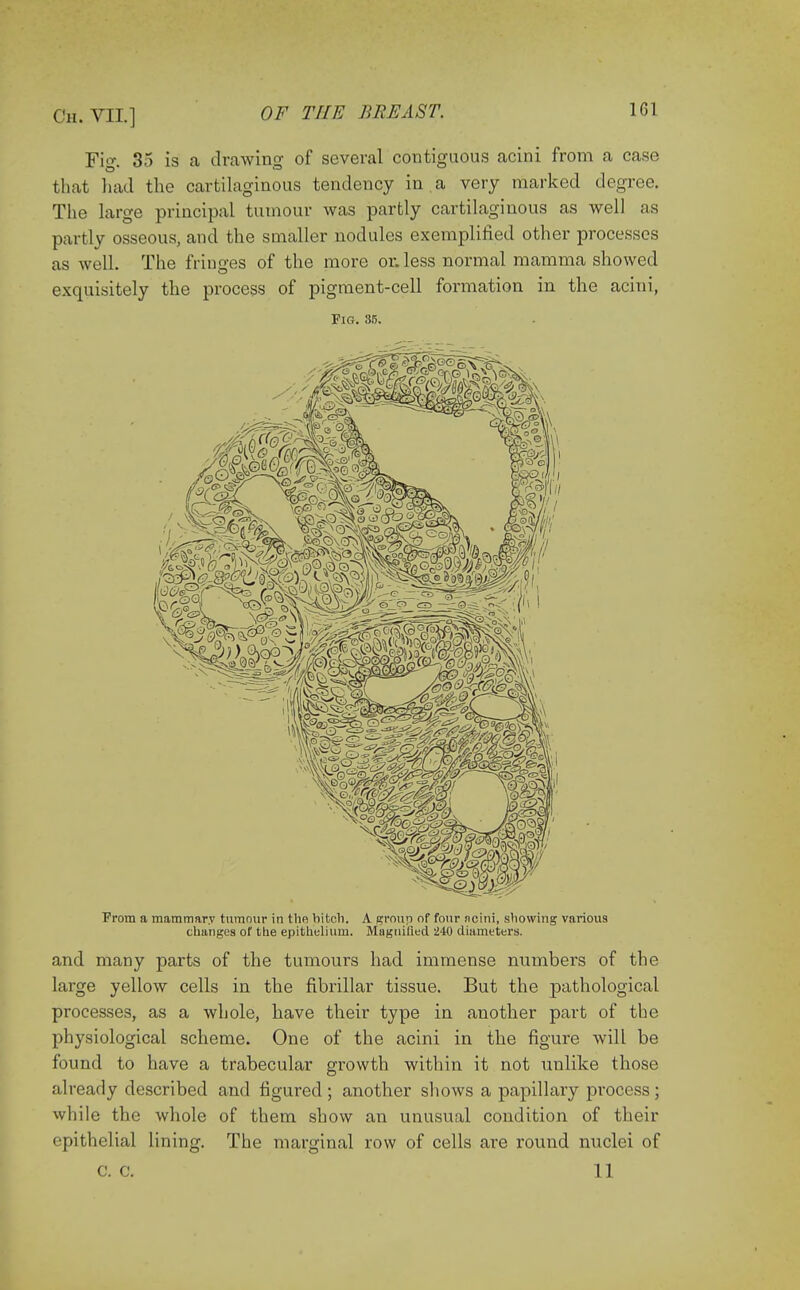 Fiff. 35 is a drawing of several contiguous acini from a case that had the cartilaginous tendency in a very marked degree. The large principal tumour was partly cartilaginous as well as partly osseous, and the smaller nodules exemplified other processes as well. The fringes of the more or. less normal mamma showed exquisitely the process of pigment-cell formation in the acini, Fig. 35. Prom a mammary tumour in the bitch. A group of four ncini, showing various changes of the epithelium. Magnified 240 diameters. and many parts of the tumours had immense numbers of the large yellow cells in the fibrillar tissue. But the pathological processes, as a whole, have their type in another part of the physiological scheme. One of the acini in the figure will be found to have a trabecular growth within it not unlike those already described and figured ; another shows a papillary process; while the whole of them show an unusual condition of their epithelial lining. The marginal row of cells are round nuclei of c. c. 11