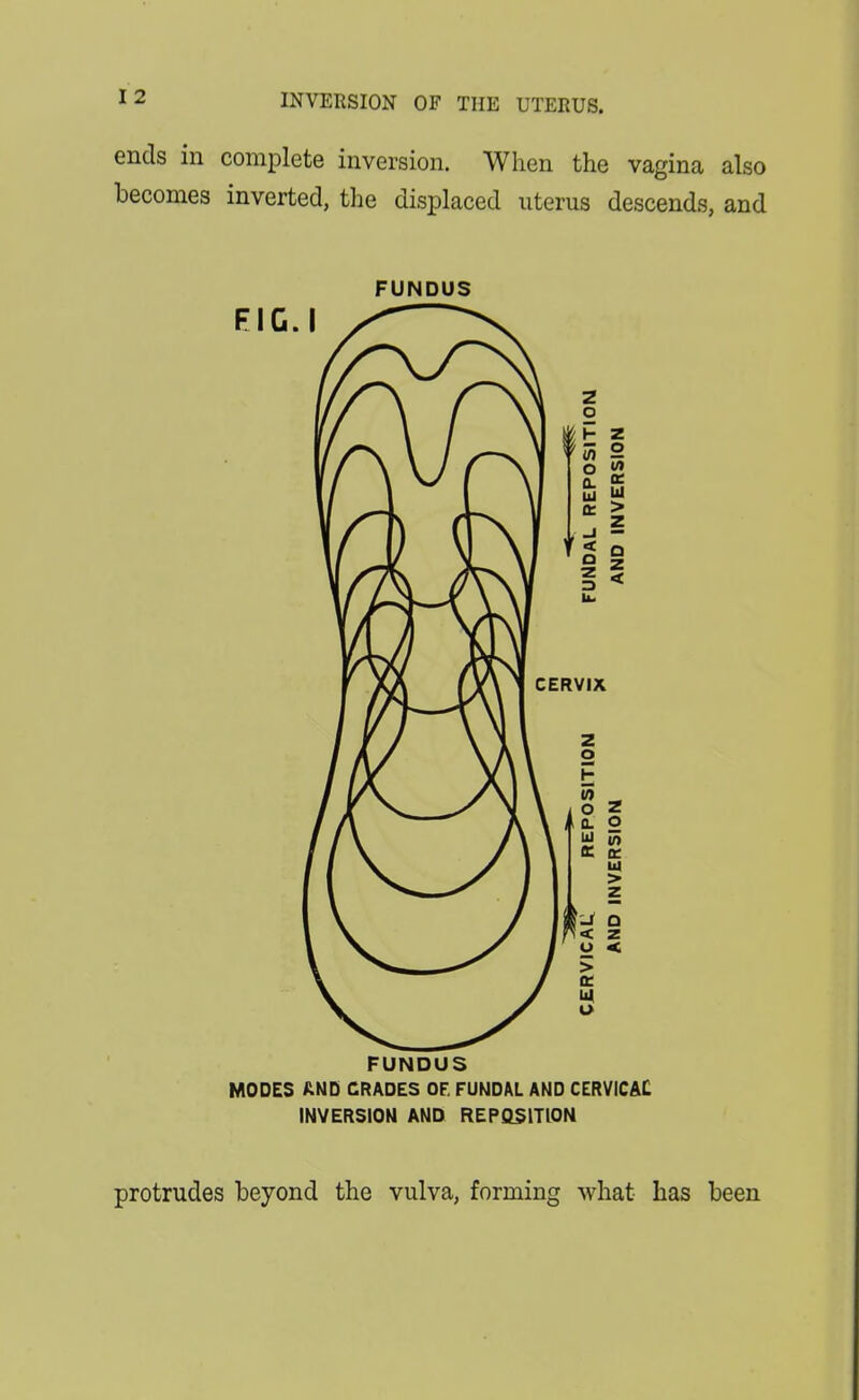 ends in complete inversion. When the vagina also becomes inverted, the displaced uterus descends, and FUNDUS FUNDUS MODES AND GRADES OF. FUNDM AND CERVICAC INVERSION AND REPOSITION protrudes beyond the vulva, forming what has been