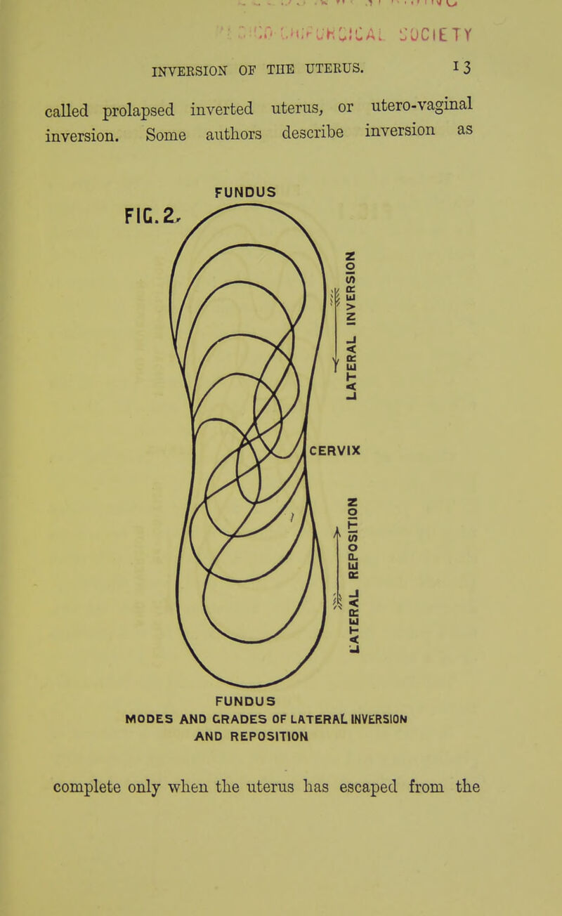 l.HirUhaiCAL. i;0ClETY INVERSION OF THE UTERUS. 13 caUed prolapsed inverted uterus, or utero-vaginal inversion. Some authors describe inversion as FUNDUS FUNDUS MOOES AND GRADES OF LATERAL INVERSION AND REPOSITION complete only when the uterus has escaped from the