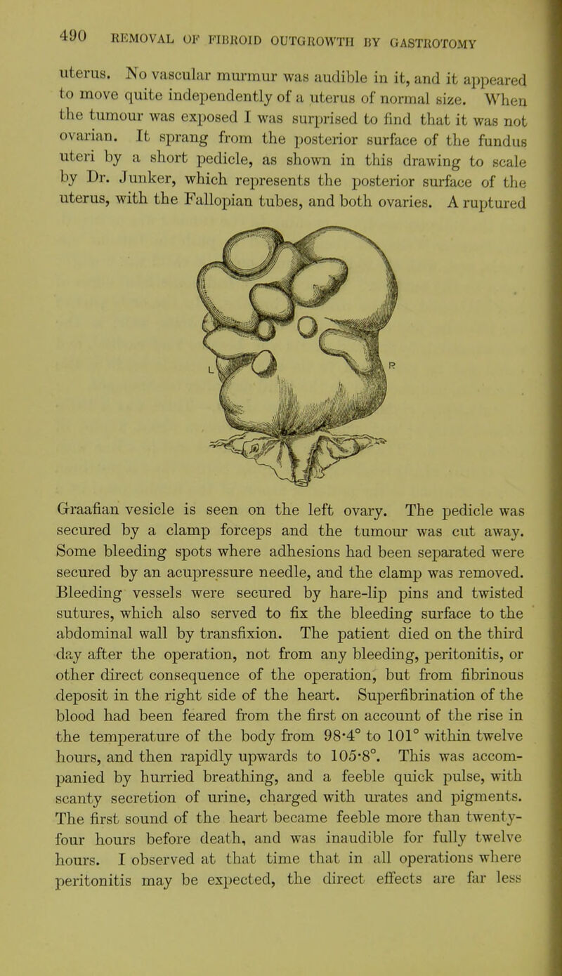uterus. No vascular murmur was audible in it, and it appeared to move quite independently of a uterus of normal size. When the tumour was exposed I was surprised to find that it was not ovai'ian. It sprang from the posterior surface of the fundus uteri by a short pedicle, as shown in this drawing to scale by Dr. Junker, which represents the posterior surface of the uterus, with the Fallopian tubes, and both ovaries. A ruptured Grraafian vesicle is seen on the left ovary. The pedicle was secured by a clamp forceps and the tumour was cut away. Some bleeding spots where adhesions had been separated were secured by an acupressure needle, and the clamp was removed. Bleeding vessels were secured by hare-lip pins and twisted sutures, which also served to fix the bleeding surface to the abdominal wall by transfixion. The patient died on the third d.iy after the operation, not from any bleeding, peritonitis, or other direct consequence of the operation, but from fibrinous deposit in the right side of the heart. Superfibrination of the blood had been feared from the first on account of the rise in the temperature of the body from 98*4° to 101° within twelve hours, and then rapidly upwards to 105'8°. This was accom- panied by hurried breathing, and a feeble quick pulse, with scanty secretion of urine, charged with urates and pigments. The first sound of the heart became feeble more than twenty- four hours before death, and was inaudible for fully twelve hours. I observed at that time that in all operations where peritonitis may be expected, the direct effects are far less
