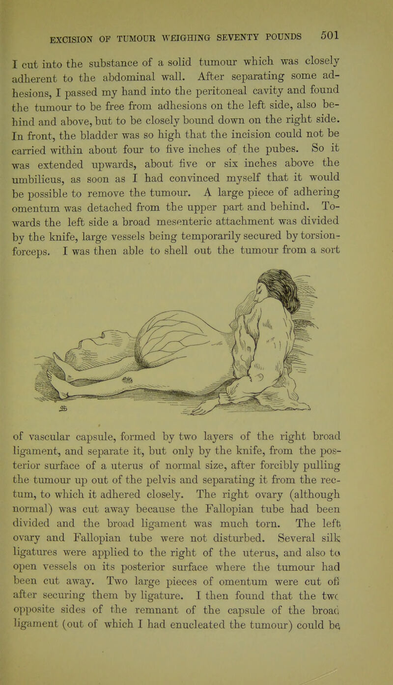 I cut into the substance of a solid tumour which was closely adherent to the abdominal wall. After separating some ad- hesions, I passed my hand into the peritoneal cavity and found the tumour to be free from adhesions on the left side, also be- hind and above, but to be closely bound down on the right side. In front, the bladder was so high that the incision could not be carried within about four to five inches of the pubes. So it was extended upwards, about five or six inches above the umbilicus, as soon as I had convinced myself that it woidd be possible to remove the tumour. A large piece of adhering omentum was detached from the upper part and behind. To- wards the left side a broad mesenteric attachment was divided by the knife, large vessels being temporarily secured by torsion- forceps. I was then able to shell out the tumour from a sort of vascular capsule, formed by two layers of the right broad ligament, and separate it, but only by the knife, from the pos- terior surface of a uterus of normal size, after forcibly pulling the tumour up out of the pelvis and separating it from the rec- tum, to which it adhered closely. The right ovary (although normal) was cut away because the Fallopian tube had been divided and the broad ligament was much torn. The left ovary and Fallopian tube were not disturbed. Several silk ligatures were applied to the right of the uterus, and also to open vessels on its posterior surface where the tumour had been cut away. Two large pieces of omentum were cut ofi after securing them by ligature. I then found that the twc opposite sides of the remnant of the capsule of the broaci ligament (out of which I had enucleated the tumour) could be