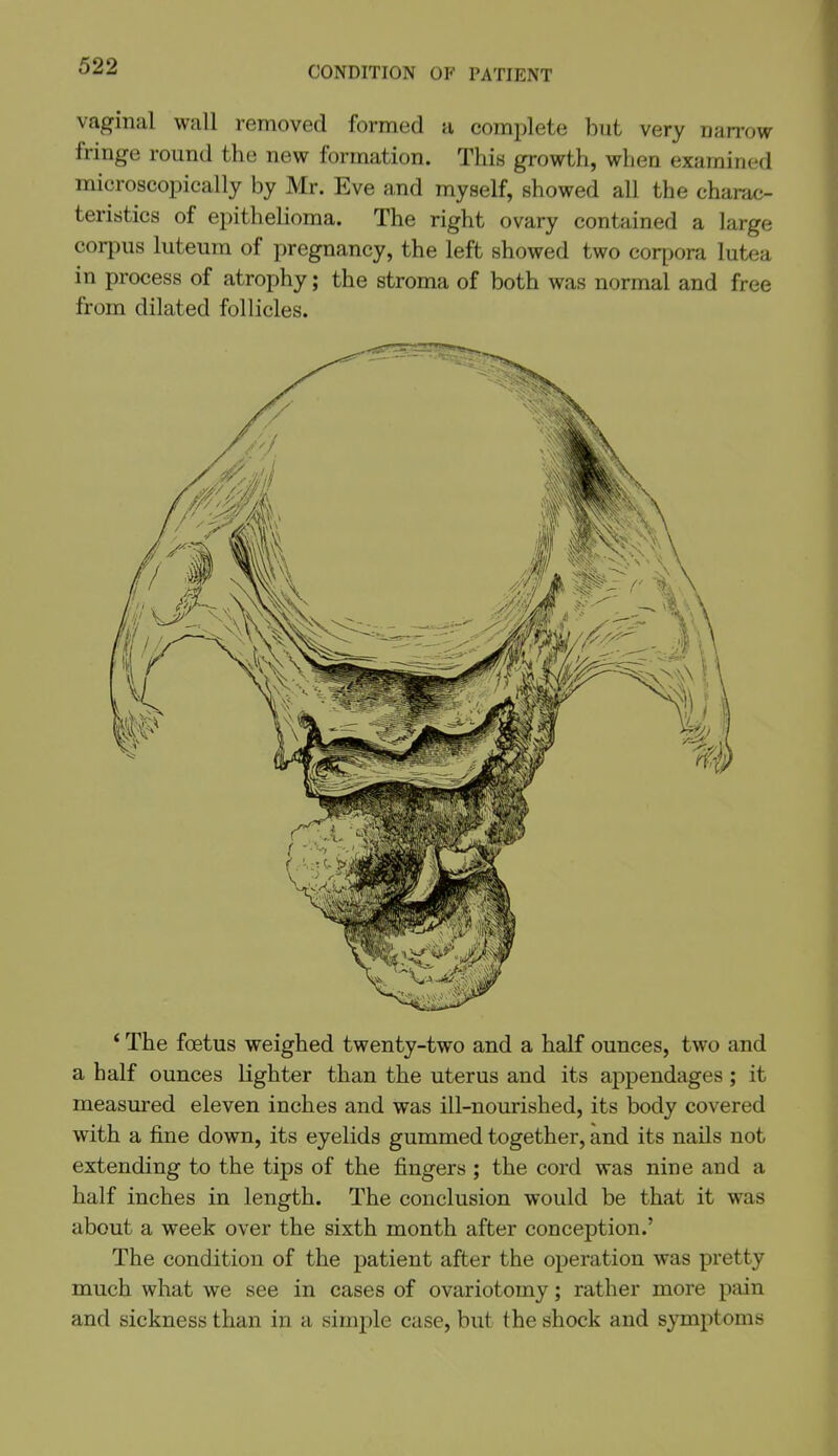 CONDITION OF PATIENT vaginal wall removed formed a comi:)lete but very narrow fringe round the new formation. This growth, when examined microscopically by Mr. Eve and myself, showed all the charac- teristics of epithelioma. The right ovary contained a large corpus luteum of pregnancy, the left showed two corpora lutea in process of atrophy; the stroma of both was normal and free from dilated follicles. * The foetus weighed twenty-two and a half ounces, two and a half ounces lighter than the uterus and its appendages; it measured eleven inches and was ill-nourished, its body covered with a fine down, its eyelids gummed together, and its nails not extending to the tips of the fingers ; the cord was nine and a half inches in length. The conclusion would be that it was about a week over the sixth month after conception.' The condition of the patient after the operation was pretty much what we see in cases of ovariotomy; rather more pain and sickness than in a simple case, but the shock and symptoms
