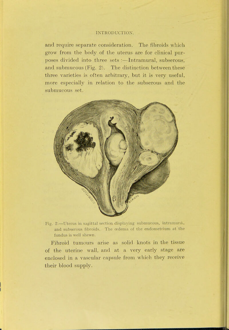 and require separate consideration. The fibroids which grow from the body of the uterus are for clinical pur- poses divided into three sets :—Intramural, subserous, and submucous (Fig. 2). The distinction between these three varieties is often arbitrary, but it is very useful, more especially in relation to the subserous and the submucous set. Fig. 2.—Uterus in sagittal section displaying submucous, intramural, and subserous fibroids. The oedema of the endometrium at the fundus is well shewn. Fibroid tumours arise as solid knots in the tissue of the uterine wall, and at a very early stage are enclosed in a vascular capsule from which they receive their blood supply. I I