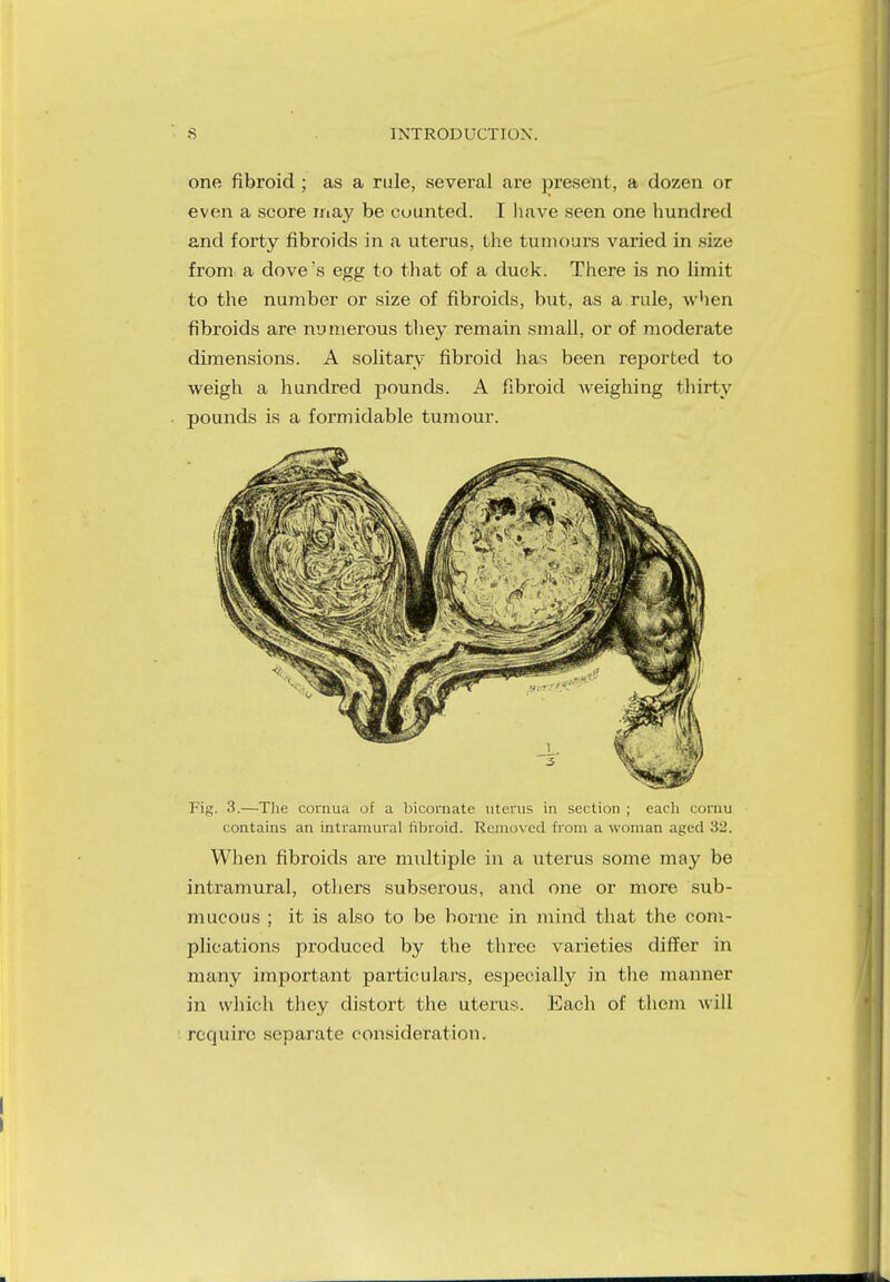 one fibroid ; as a rule, several are present, a dozen or even a score may be counted. T have seen one hundred and forty fibroids in a uterus, the tumours varied in size from a dove's egg to that of a duck. There is no limit to the number or size of fibroids, but, as a rule, when fibroids are numerous they remain small, or of moderate dimensions. A solitary fibroid has been reported to weigh a hundred pounds. A fibroid weighing thirty pounds is a formidable tumour. Fig. 3.—The cornua of a bicornate uterus in section ; each comu contains an intramural fibroid. Removed from a woman aged 32. When fibroids are multiple in a uterus some may be intramural, others subserous, and one or more sub- mucous ; it is also to be borne in mind that the com- plications produced by the three varieties differ in many important particulars, especially in the manner in which they distort the uterus. Each of them will require separate consideration.