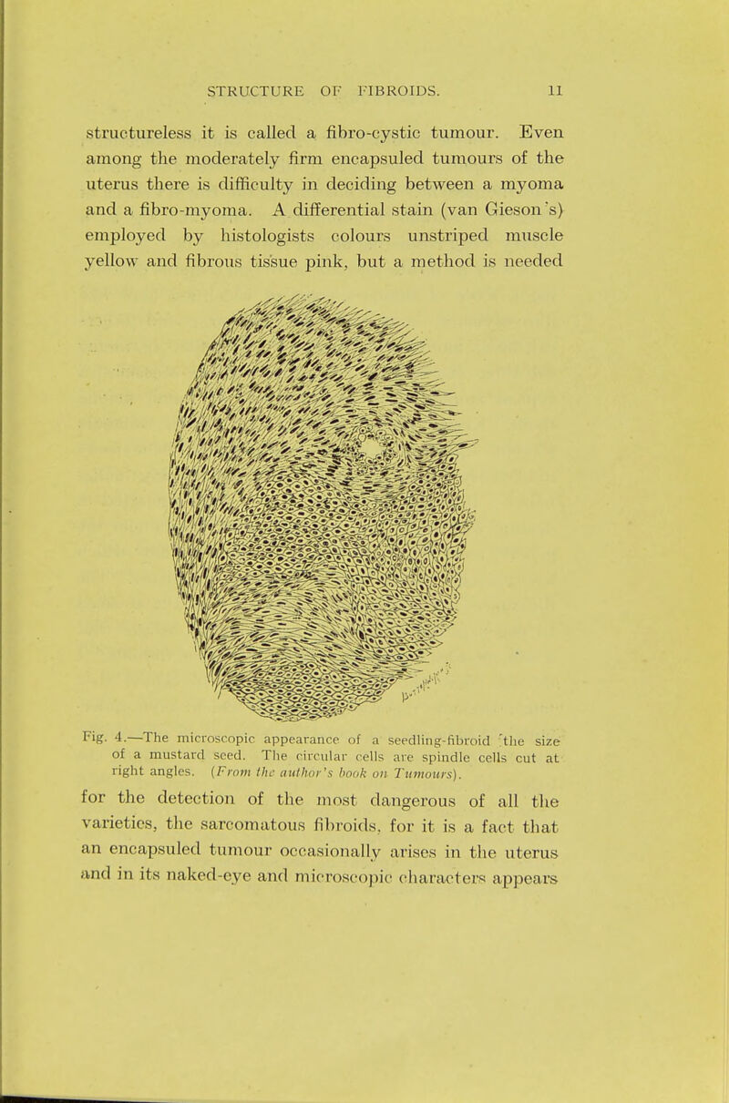structureless it is called a fibrocystic tumour. Even among the moderately firm encapsuled tumours of the uterus there is difficulty in deciding between a myoma and a fibro-myoma. A differential stain (van Giesoivs) employed by histologists colours unstriped muscle yellow and fibrous tissue pink, but a method is needed Fig. 4.—The microscopic appearance of a seedling-fibroid 'the size of a mustard seed. The circular cells are spindle cells cut at right angles. {From the author's hook on Tumours). for the detection of the most dangerous of all the varieties, the sarcomatous fibroids, for it is a fact that an encapsuled tumour occasionally arises in the uterus and in its naked-eye and microscopic characters appears