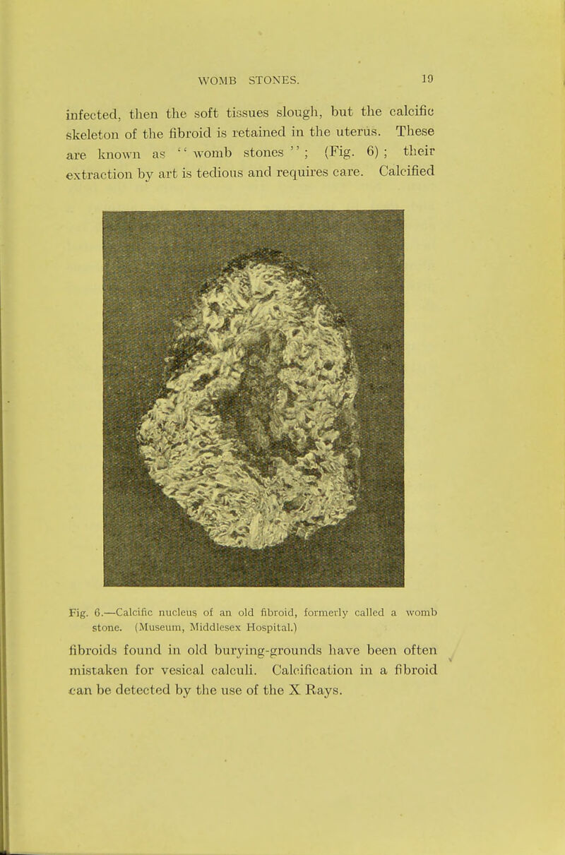 WOMB STONES. JO infected, then the soft tissues slough, but the calcific skeleton of the fibroid is retained in the uterus. These are known as '' womb stones '' ; (Fig. 6) ; their extraction by art is tedious and requires care. Calcified Fig. 6.—Calcific nucleus of an old fibroid, formerly called a womb stone. (Museum, Middlesex Hospital.) fibroids found in old burying-grounds have been often mistaken for vesical calculi. Calcification in a fibroid can be detected by the use of the X Rays.