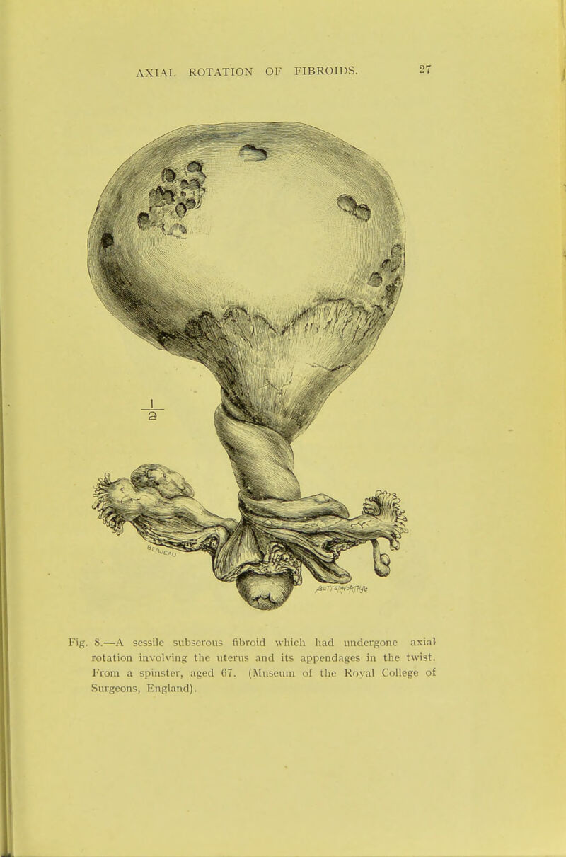 8.—A sessile subserous fibroid which had undergone axial rotation involving the uterus and its appendages in the twist. From a spinster, aged 07. (Museum ol the Royal College of Surgeons, England).