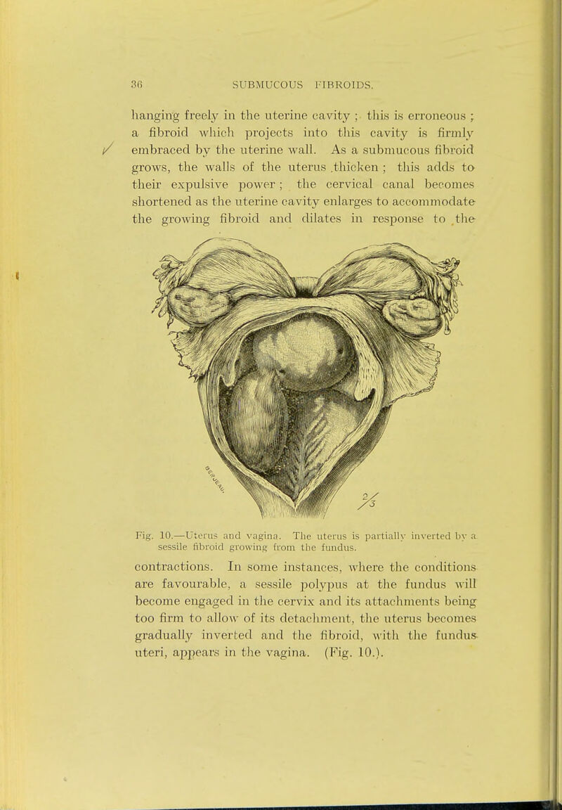 hanging freely in the uterine cavity ; this is erroneous ; a fibroid which projects into this cavity is firmly embraced by the uterine wall. As a submucous fibroid grows, the Avails of the uterus .thicken ; this adds to their expulsive power; the cervical canal becomes shortened as the uterine cavity enlarges to accommodate the growing fibroid and dilates in response to the Fig. 10.—Uterus and vagina. The uterus is partially inverted by a sessile fibroid growing from the fundus. contractions. In some instances, where the conditions are favourable, a sessile polypus at the fundus will become engaged in the cervix and its attachments being too firm to allow of its detachment, the uterus becomes gradually inverted and the fibroid, with the fundus- uteri, appears in the vagina. (Fig. 10.).