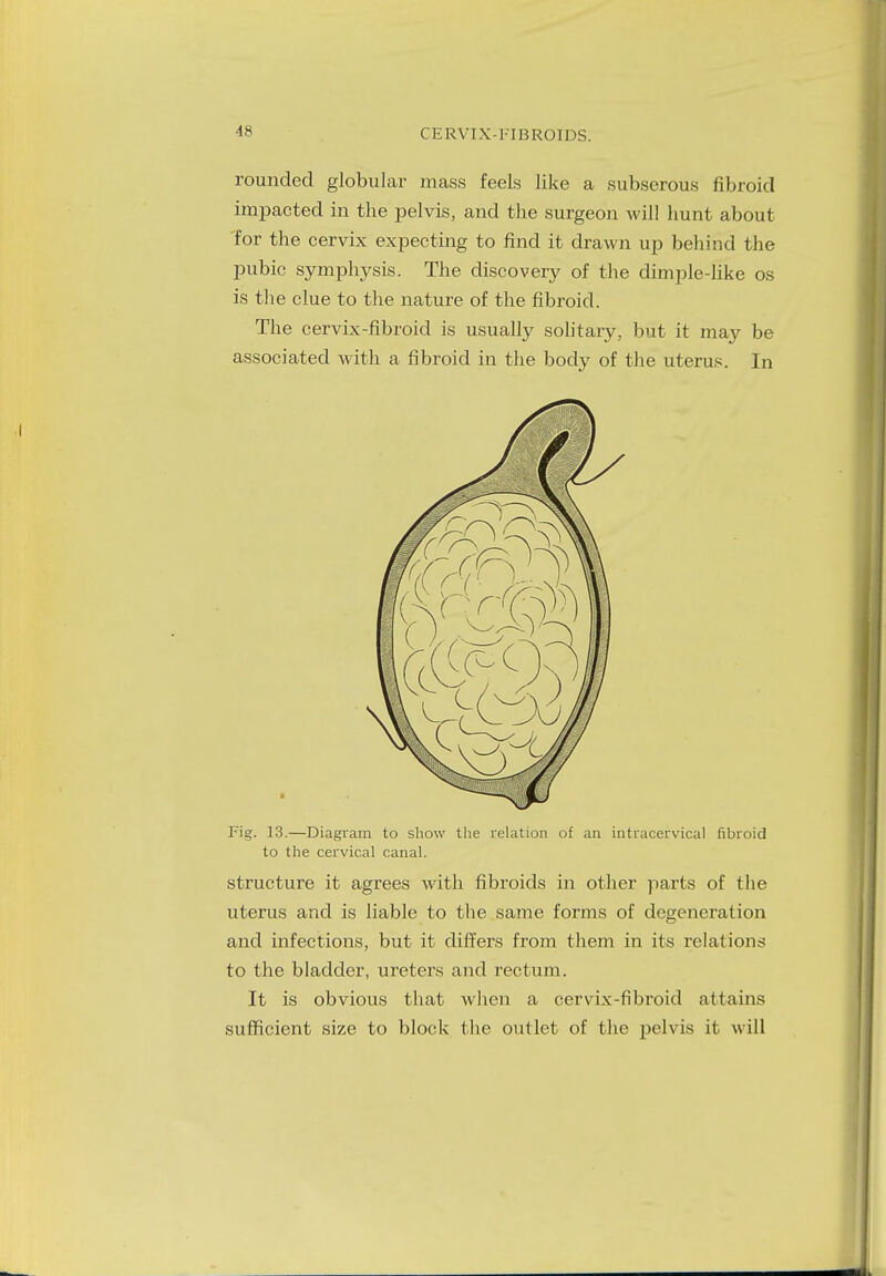 rounded globular mass feels like a subserous fibroid impacted in the pelvis, and the surgeon will hunt about for the cervix expecting to find it drawn up behind the pubic symphysis. The discovery of the dimple-like os is the clue to the nature of the fibroid. The cervix-fibroid is usually solitary, but it may be associated with a fibroid in the body of the uterus. In Fig. 13.—Diagram to show the relation of an intracervical fibroid to the cervical canal. structure it agrees with fibroids in other parts of the uterus and is liable to the same forms of degeneration and infections, but it differs from them in its relations to the bladder, ureters and rectum. It is obvious that when a cervix-fibroid attains sufficient size to block the outlet of the pelvis it will