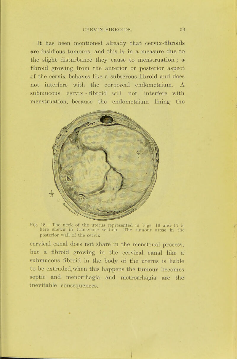 It has been mentioned already that cervix-fibroids are insidious tumours, and this is in a measure due to the slight disturbance they cause to menstruation ; a fibroid growing from the anterior or posterior aspect of the cervix behaves like a subserous fibroid and does not interfere with the corporeal endometrium. A submucous cervix - fibroid will not interfere with menstruation, because the endometrium fining the Fig. 18.—The neck of the uterus represented in Figs. 16 and 17 is here shewn in transverse section. The tumour arose in the posterior wall of the cervix. cervical canal does not share in the menstrual process, but a fibroid growing in the cervical canal like a submucous fibroid in the body of the uterus is liable to be extruded,when this happens the tumour becomes septic and menorrhagia and metrorrhagia are the inevitable consequences. I