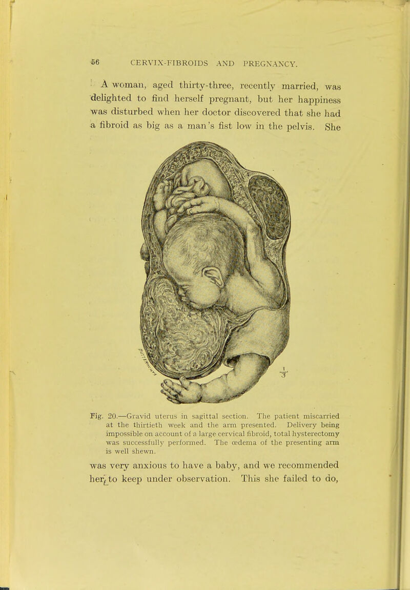 A woman, aged thirty-three, recently married, was delighted to find herself pregnant, but her happiness was disturbed when her doctor discovered that she had a fibroid as big as a man's fist low in the pelvis. She Fig. 20.—Gravid uterus in sagittal section. The patient miscarried at the thirtieth week and the arm presented. Delivery being impossible on account of a large cervical fibroid, total hysterectomy was successfully performed. The oedema of the presenting arm is well shewn. was very anxious to have a baby, and we recommended hereto keep under observation. This she failed to do,