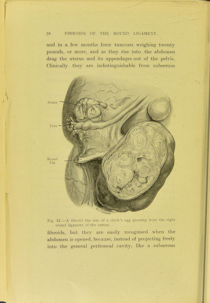 and in a few months form tumours weighing twenty pounds, or more, and as they rise into the abdomen drag the uterus and its appendages out of the pelvis. Clinically they are indistinguishable from subserous Fig. 21.—A fibroid the size of a cluck's egg growing from the right round ligament of the uterus. fibroids, but they are easily recognised when the abdomen is opened, because, instead of projecting freely into the general peritoneal cavity, like a subserous