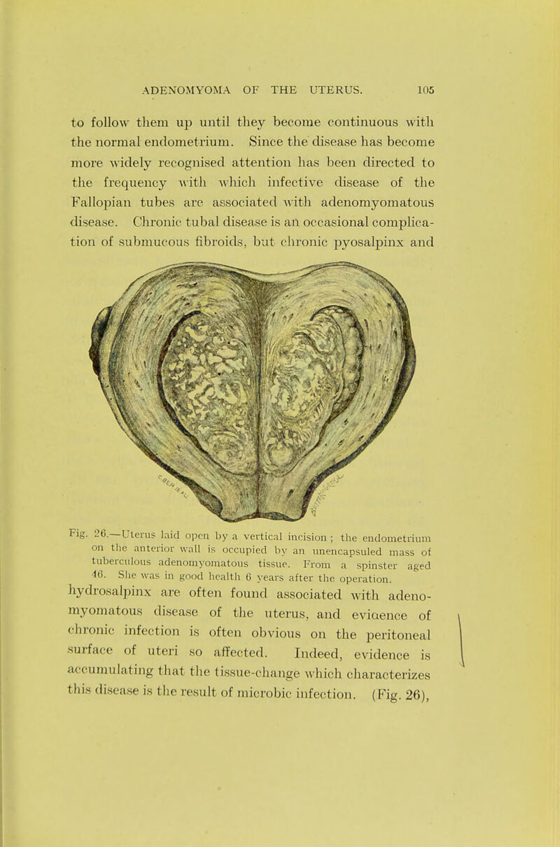 to follow them up until they become continuous with the normal endometrium. Since the disease has become more widely recognised attention has been directed to the frequency with which infective disease of the Fallopian tubes are associated with adenomyomatous disease. Chronic tubal disease is an occasional complica- tion of submucous fibroids, but chronic pyosalpinx and Fig. 26.—Uterus laid open by a vertical incision ; the endometrium on the anterior wall is occupied by an unencapsuled mass of tuberculous adenomyomatous tissue. From a spinster aged 46. She was in good health 6 years after the. operation. hydrosalpinx are often found associated with adeno- myomatous disease of the uterus, and eviaence of chronic infection is often obvious on the peritoneal •surface of uteri so affected. Indeed, evidence is accumulating that the tissue-change which characterizes this disease is (he result of microbic infection. (Fig. 26),