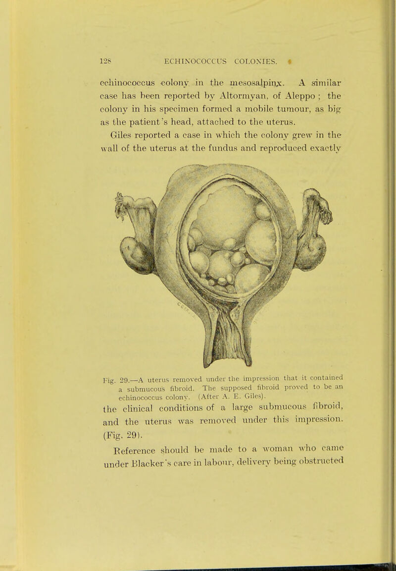 echinococcus colony in the mesosalpinx. A similar case has been reported by Altormyan, of Aleppo ; the colony in his specimen formed a mobile tumour, as big as the patient's head, attached to the uterus. Giles reported a case in which the colony grew in the wall of the uterus at the fundus and reproduced exactly Fig. 29.—A uterus removed under the impression that it contained a submucous fibroid. The supposed fibroid proved to be an echinococcus colony. (After A. E. Giles). the clinical conditions of a large submucous fibroid, and the uterus was removed under this impression. (Fig. 29). Reference should be made to a woman who came under Blacker's care in labour, delivery being obstructed