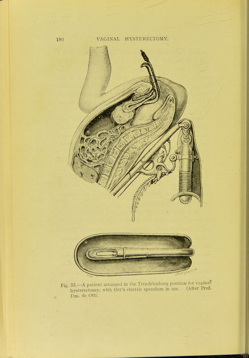 35 _A patient arranged in the Trendelenburg position for vaginal hysterectomy, with Ott's electric speculum in use. (After Prof. Dm. de Ott).