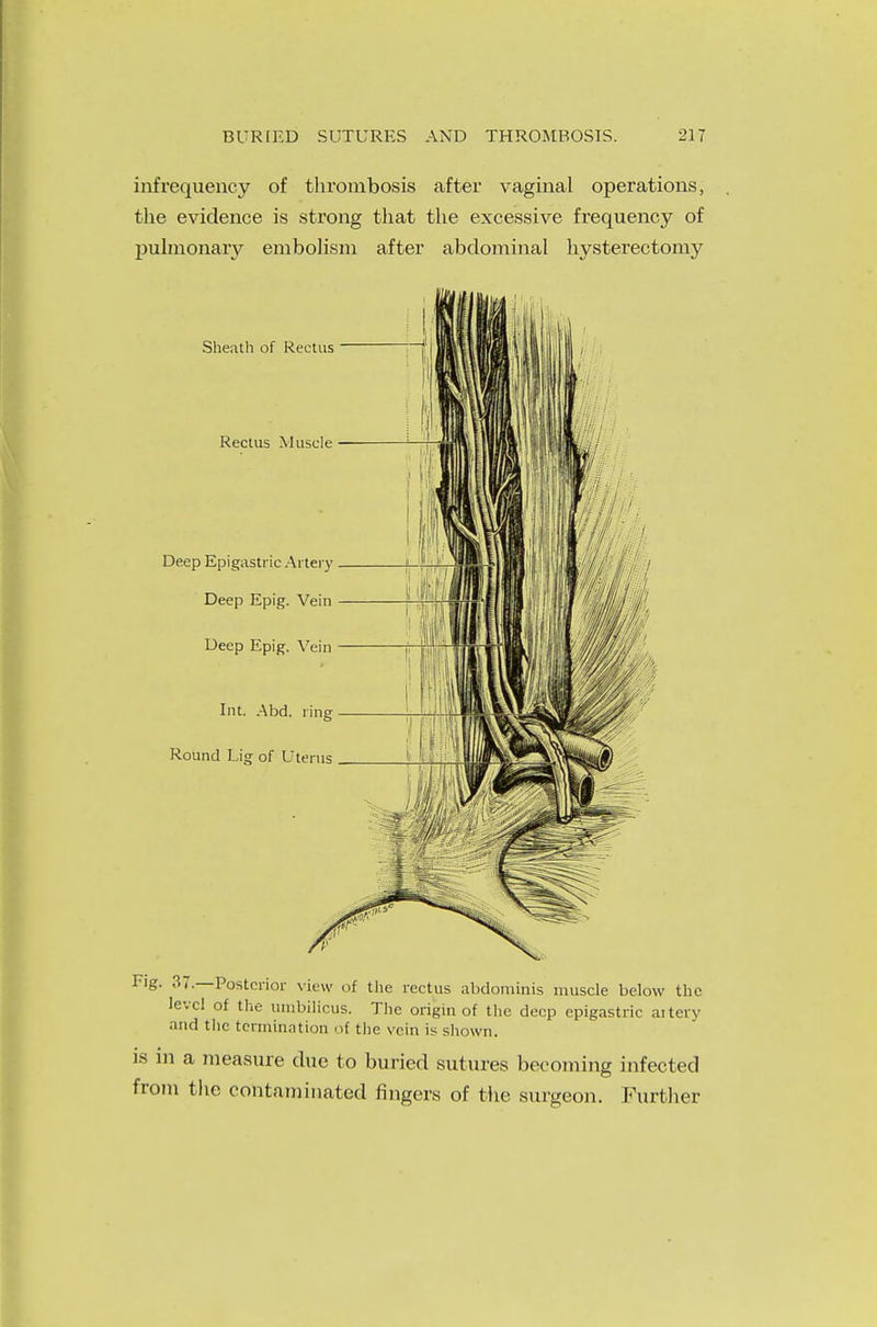 iiifrequency of thrombosis after vaginal operations, the evidence is strong that the excessive frequency of pulmonary embolism after abdominal hysterectomy Fig. 37.—Posterior view of the rectus abdominis muscle below the level of the umbilicus. The origin of the deep epigastric ai tery and the termination of the vein is shown. is in a measure due to buried sutures becoming infected from the contaminated fingers of the surgeon. Further