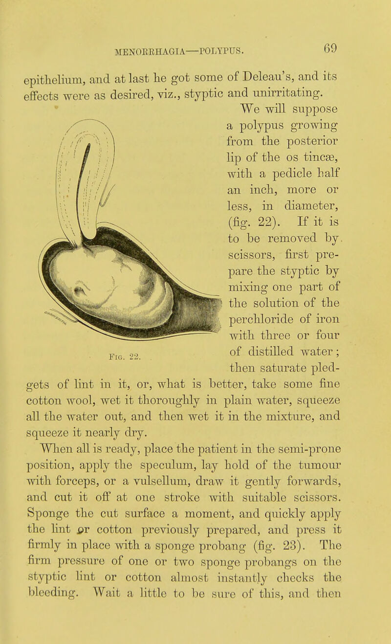 epithelium, and at last lie got some of Deleau's, and its effects were as desired, viz., styptic and unirritating. We will suppose a polypus growing from tlie posterior lip of the OS tincse, with a pedicle half an inch, more or less, in diameter, (fig. 22). If it is to be removed by. scissors, first pre- pare the styptic by mixing one part of the solution of the perchloride of iron with three or four of distilled water; then saturate pled- gets of lint in it, or, what is better, take some fine cotton wool, wet it thoroughly in plain water, squeeze all the water out, and then wet it in the mixture, and squeeze it nearly dry. Wlien all is ready, place the patient in the semi-prone position, apply the speculum, lay hold of the tumour with forceps, or a vulsellum, draw it gently forwards, and cut it off at one stroke with suitable scissors. Sponge the cut surface a moment, and quickly apply the lint jpr cotton previously prepared, and press it firmly in place with a sponge probang (fig. 23). The firm pressure of one or two sponge probangs on the styptic lint or cotton almost instantly checks the bleeding. Wait a little to be sure of this, and tlien