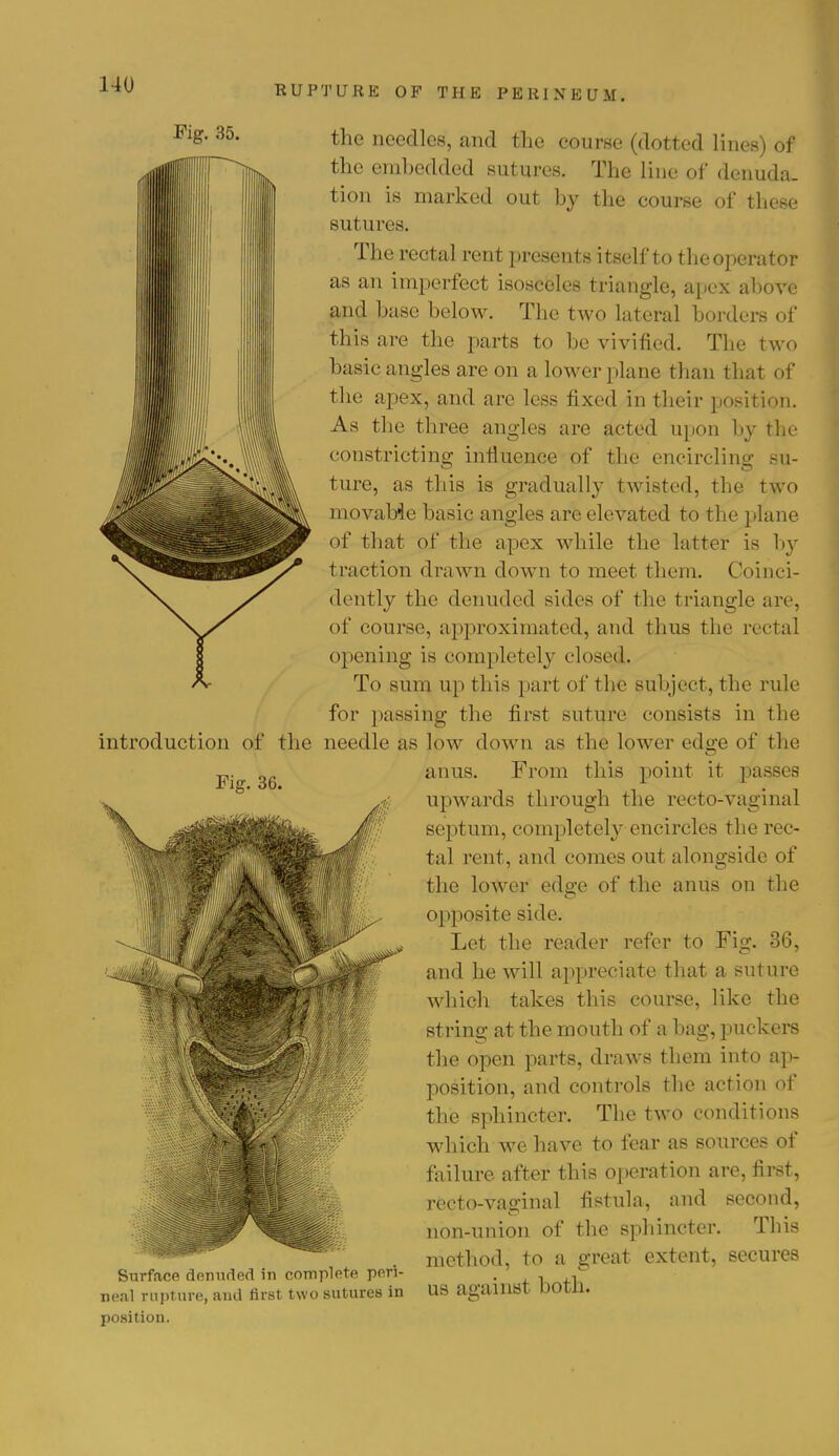 Fig. 35. the needles, and the course (dotted lines) of the embedded sutures. The line of denuda- tion is marked out by the course of these sut urea. The rectal rent presents itself to the operator as an imperfect isosceles triangle, apex above and base below. The two lateral borders of this are the parts to be vivified. The two basic angles are on a lower plane than that of the apex, and arc less fixed in their position. As the three angles are acted upon by the constricting influence of the encircling su- ture, as this is gradually twisted, the two movable basic angles are elevated to the plane of that of the apex while the latter is by traction drawn clown to meet them. Coinci- dently the denuded sides of the triangle are, of course, approximated, and thus the rectal opening is completely closed. To sum up this part of the subject, the rule for passing the first suture consists in the introduction of the needle as low down as the lower eds;e of the anus. From this point it passes upwards through the recto-vaginal septum, completely encircles the rec- tal rent, and comes out alongside of the lower edge of the anus on the opposite side. Let the reader refer to Fig. 36, and he will appreciate that a suture which takes this course, like the string at the mouth of a bag, puckers the open parts, draws them into ap- position, and controls the action of the sphincter. The two conditions which we have to fear as sources of failure after this operation are, first, recto-vaginal fistula, and second, non-union of the sphincter. Tins method, to a great extent, secures Surface denuded in complete pen- .  neal rupture, and first two sutures in US against DOtU. position. Fig. 36.