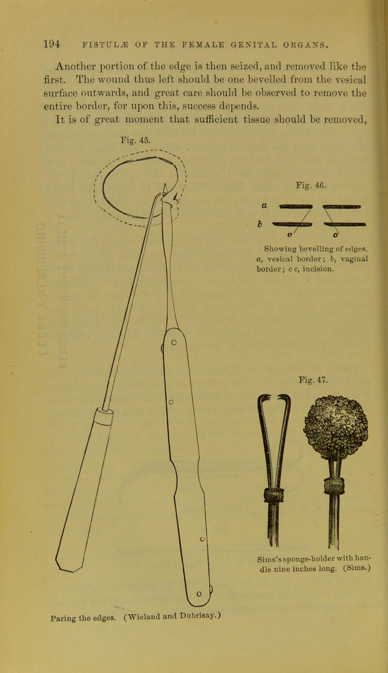 Another portion of the edge is then seized, and removed like the first. The wound thus left should he one bevelled from the vesical surface outwards, and great care should be observed to remove the entire border, for upon this, success depends. It is of great moment that sufficient tissue should be removed, Fig. 45. Siuis's sponge-holder with han- dle nine inches long. (Sims.) O Paring the edges. (Wieland and Dubrisay.)