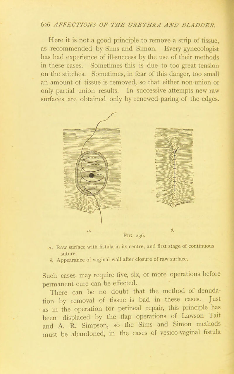 Here it is not a good principle to remove a strip of tissue, as recommended by Sims and Simon. Every gynecologist has had experience of ill-success by the use of their methods in these cases. Sometimes this is due to too great tension on the stitches. Sometimes, in fear of this danger, too small an amount of tissue is removed, so that either non-union or only partial union results. In successive attempts new raw surfaces are obtained only by renewed paring of the edges. Fig. 236. a. Raw surface with fistula in its centre, and first stage of continuous suture. b. Appearance of vaginal wall after closure of raw surface. Such cases may require five, six, or more operations before permanent cure can be effected. There can be no doubt that the method of denuda- tion by removal of tissue is bad in these cases. Just as in the operation for perineal repair, this principle has been displaced by the flap operations of Lawson Tait and A. R. Simpson, so the Sims and Simon methods must be abandoned, in the cases of vesico-vaginal fistula