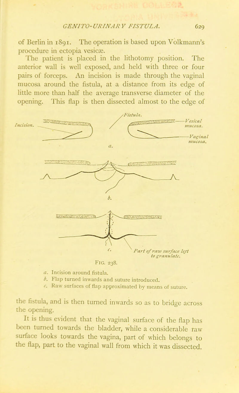 of Berlin in 1891. The operation is based upon Volkmann's procedure in ectopia vesica;. The patient is placed in the lithotomy position. The anterior wall is well exposed, and held with three or four pairs of forceps. An incision is made through the vaginal mucosa around the fistula, at a distance from its edge of little more than half the average transverse diameter of the opening. This flap is then dissected almost to the edge of to granulate. FlG. 238. a. Incision around fistula. b. Flap turned inwards and suture introduced. c. Raw surfaces of flap approximated by means of suture. the fistula, and is then turned inwards so as to bridge across the opening. It is thus evident that the vaginal surface of the flap has been turned towards the bladder, while a considerable raw surface looks towards the vagina, part of which belongs to the flap, part to the vaginal wall from which it was dissected.
