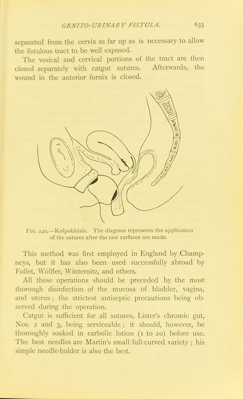 separated from the cervix as far up as is necessary to allow the fistulous tract to be well exposed. The vesical and cervical portions of the tract are then closed separately with catgut sutures. Afterwards, the wound in the anterior fornix is closed. Fig. 240.—Kolpokleisis. The diagram represents the application of the sutures after the raw surfaces are made. This method was first employed in England by Champ- neys, but it has also been used successfully abroad by Follet, Wolfler, Winternitz, and others. All these operations should be preceded by the most thorough disinfection of the mucosa of bladder, vagina, and uterus; the strictest antiseptic precautions being ob- served during the operation. Catgut is sufficient for all sutures, Lister's chromic gut, Nos. 2 and 3, being serviceable; it should, however, be thoroughly soaked in carbolic lotion (1 to 20) before use. The best needles are Martin's small full-curved variety; his simple needle-holder is also the best.