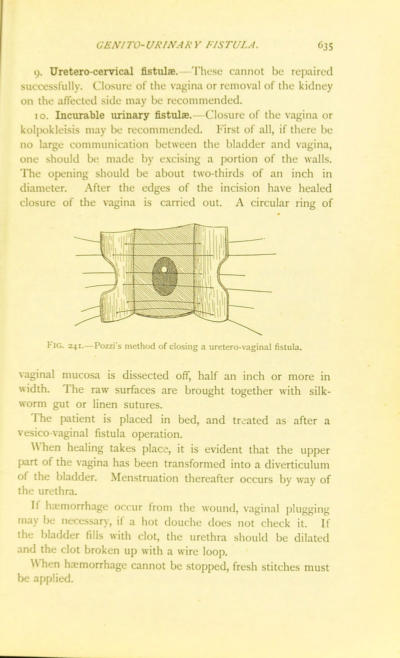 9. Uretero-cervical fistulae.— These cannot be repaired successfully. Closure of the vagina or removal of the kidney on the affected side may be recommended. 10. Incurable urinary fistulae.—Closure of the vagina or kolpokleisis may be recommended. First of all, if there be no large communication between the bladder and vagina, one should be made by excising a portion of the walls. The opening should be about two-thirds of an inch in diameter. After the edges of the incision have healed closure of the vagina is carried out. A circular ring of Fig. 241.—Pozzi's method of closing a uretero-vaginal fistula. vaginal mucosa is dissected off, half an inch or more in width. The raw surfaces are brought together with silk- worm gut or linen sutures. The patient is placed in bed, and treated as after a vesico-vaginal fistula operation. When healing takes place, it is evident that the upper part of the vagina has been transformed into a diverticulum of the bladder. Menstruation thereafter occurs by way of the urethra. If haemorrhage occur from the wound, vaginal plugging may be necessary, if a hot douche does not check it. If the bladder fills with clot, the urethra should be dilated and the clot broken up with a wire loop. When haemorrhage cannot be stopped, fresh stitches must be applied.