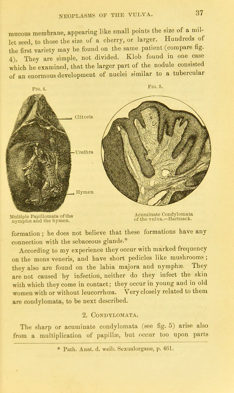 mucous membrane, appearing like small points the size of a mil- let seed, to those the size of a cherry, or larger. Hundreds of the first variety may be found on the same patient (compare fig. 4), They are simple, not divided. Klob found in one case which he examined, that the larger part of the nodule consisted of an enormous development of nuclei similar to a tubercular Fig. i. Fig. 5. Clitoris Urethra Hymen Multiple Papillomata of the nymphse and the hymen. Acuminate Condylomata of the vulva.—Hartnack. formation ; he does not believe that these formations have any connection with the sebaceous glands.* According to my experience they occur with marked frequency on the mons veneris, and have short pedicles like mushrooms ; they also are found on the labia majora and nymphse. They are not caused by infection, neither do they infect the skin with which they come in contact; they occur in young and in old women with or without leucorrhcea. Very closely related to them are condylomata, to be next described. 2. Condylomata. The sharp or acuminate condylomata (see fig. 5) arise also from a multiplication of papillje, but occur too upon parts * Path. Anat. d. weib. Sexualorgane, p. 461.